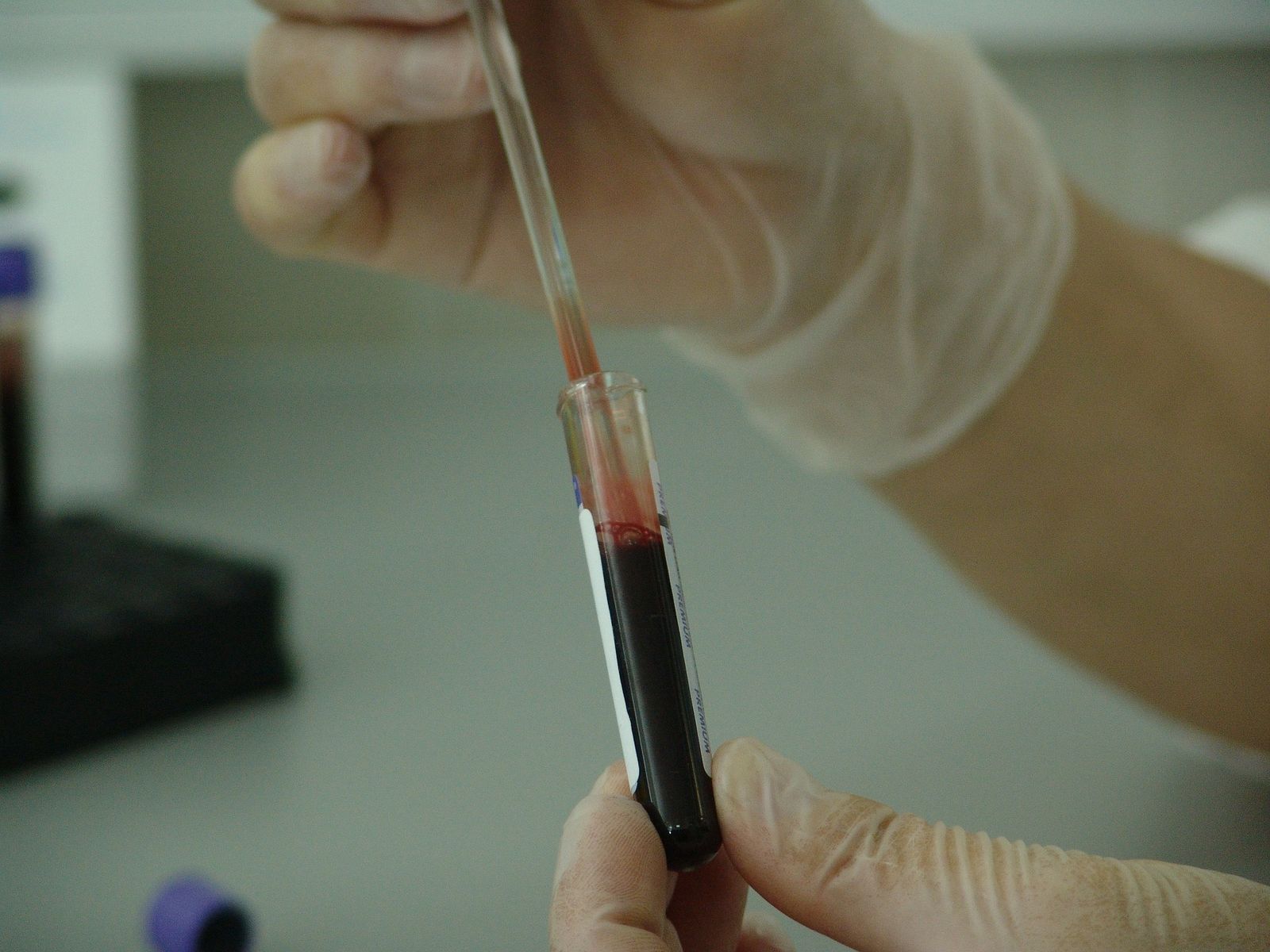 Un análisis de sangre puede detectar el cáncer de pulmón cuatro años antes de que aparezca