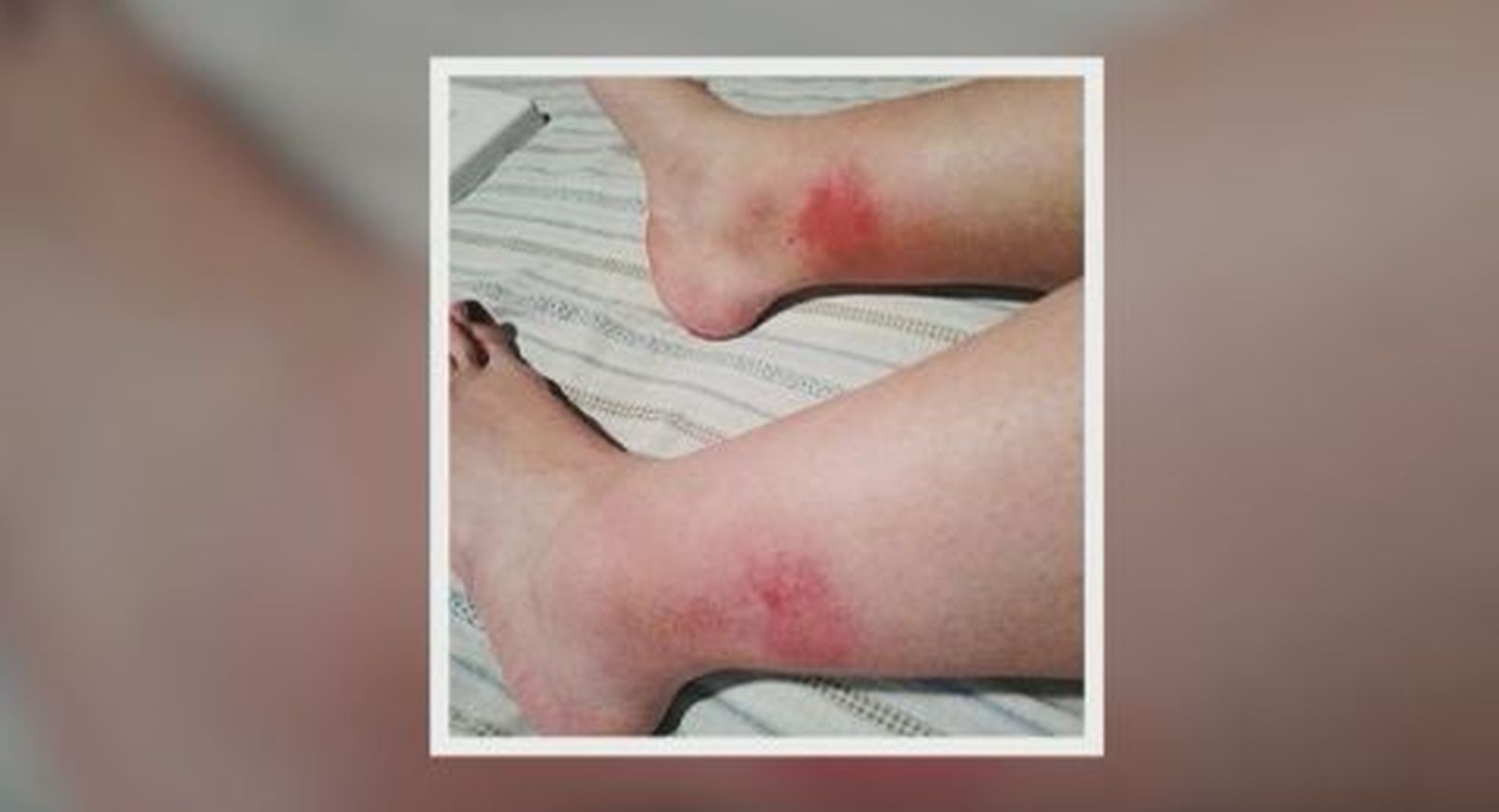 Vecinos de Villaverde denuncian las mordeduras que sufren de la mosca negra