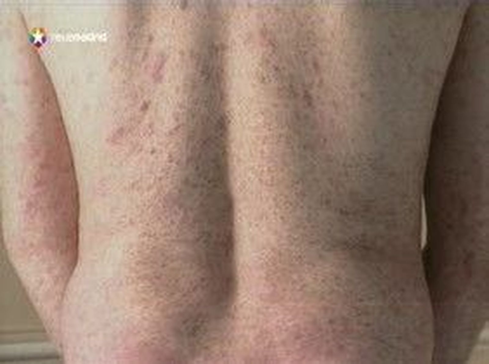 día psoriasis