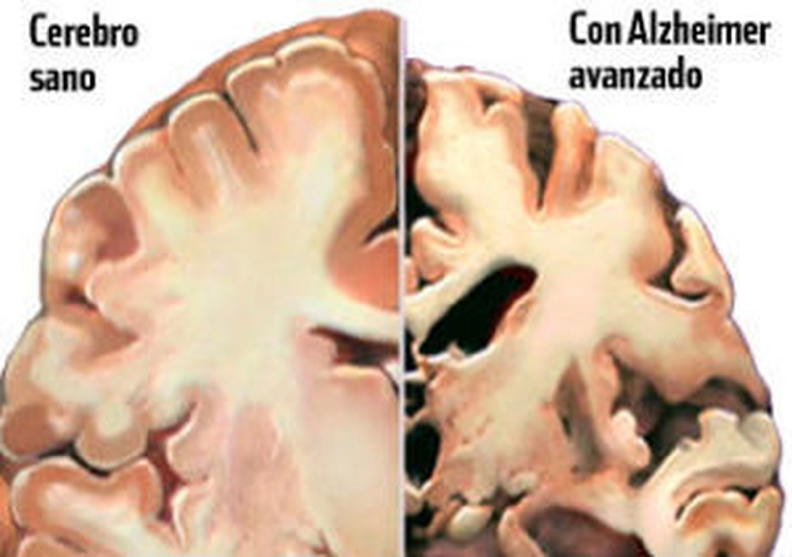 alzheimer-avanzado.jpg