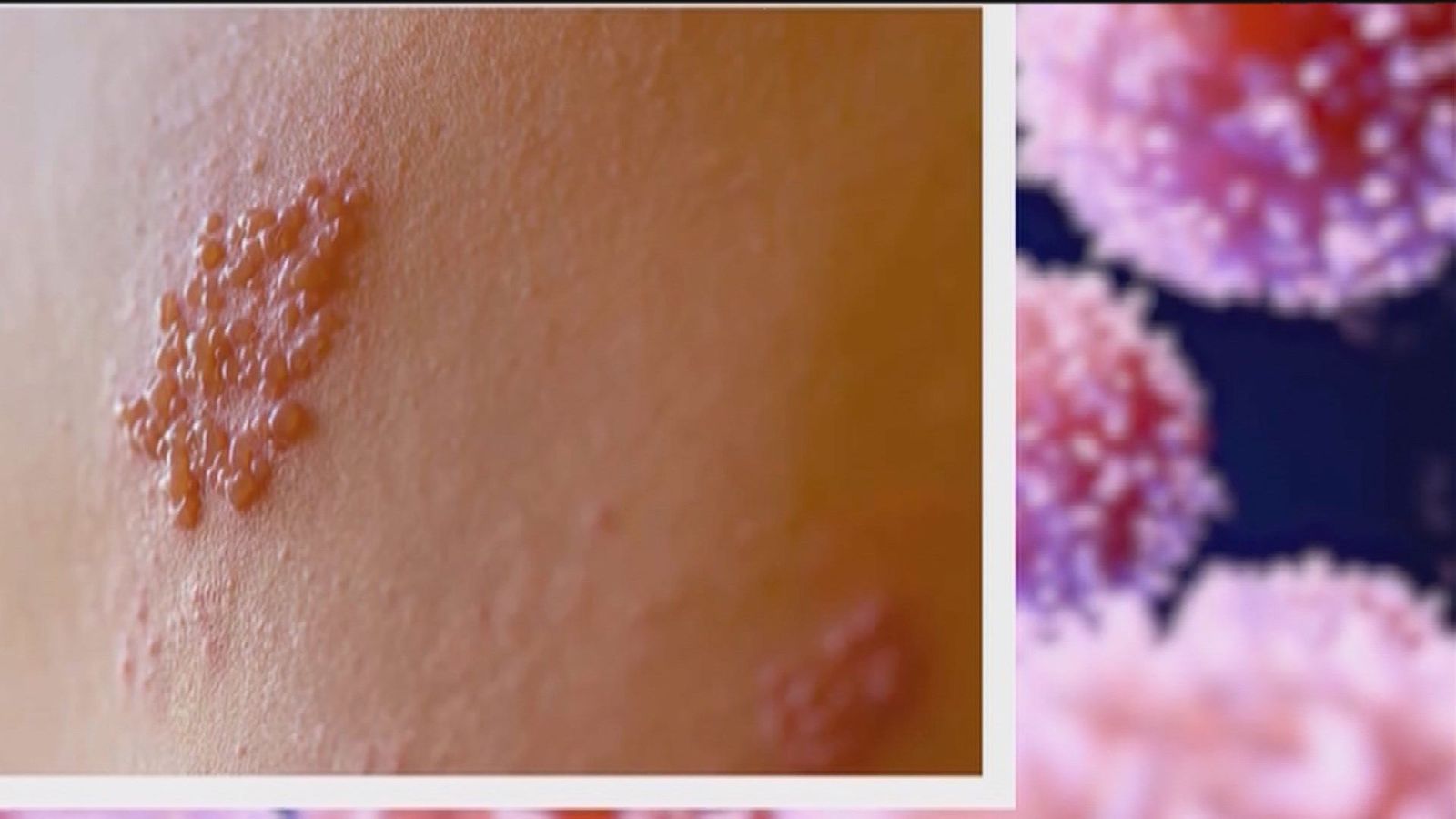 Qué es el herpes zóster y por qué Madrid solo vacunará contra el virus a los nacidos en 1957 y 1942