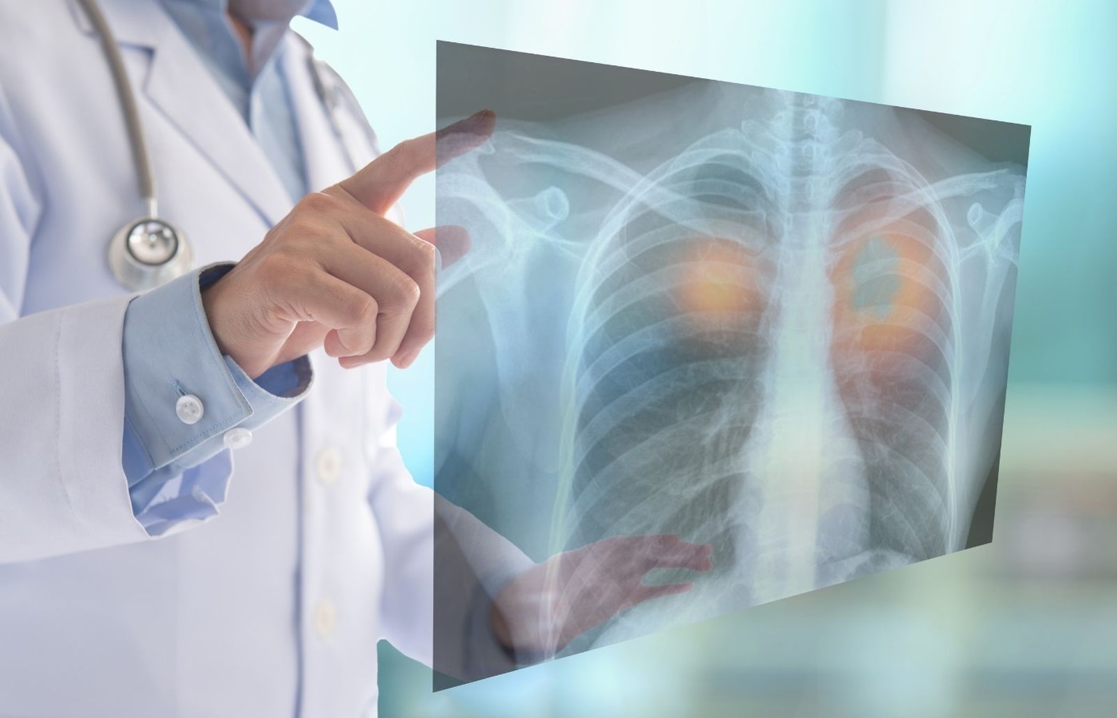 Cáncer de pulmón