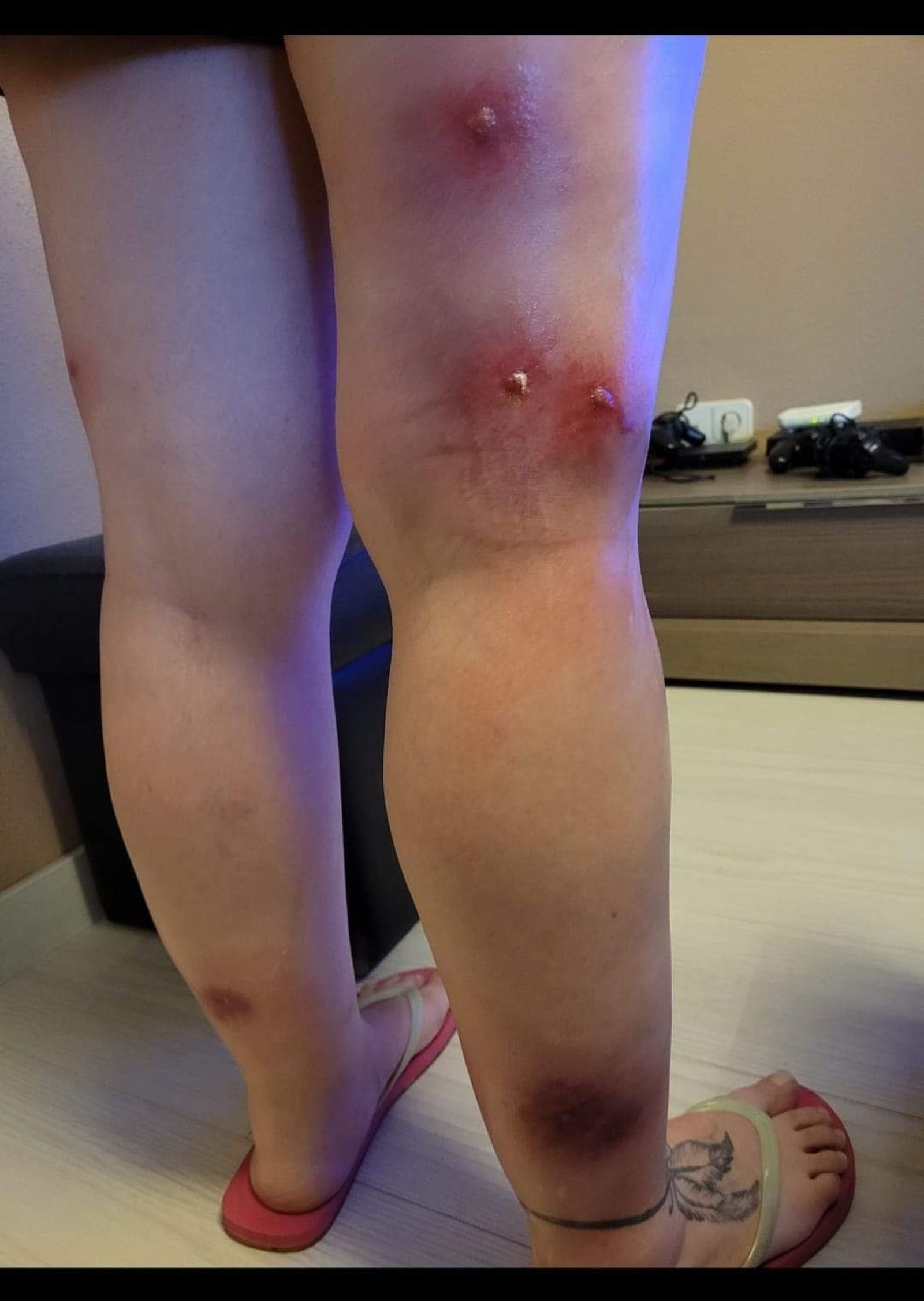 Mordiscos de mosca negra en las piernas de una mujer