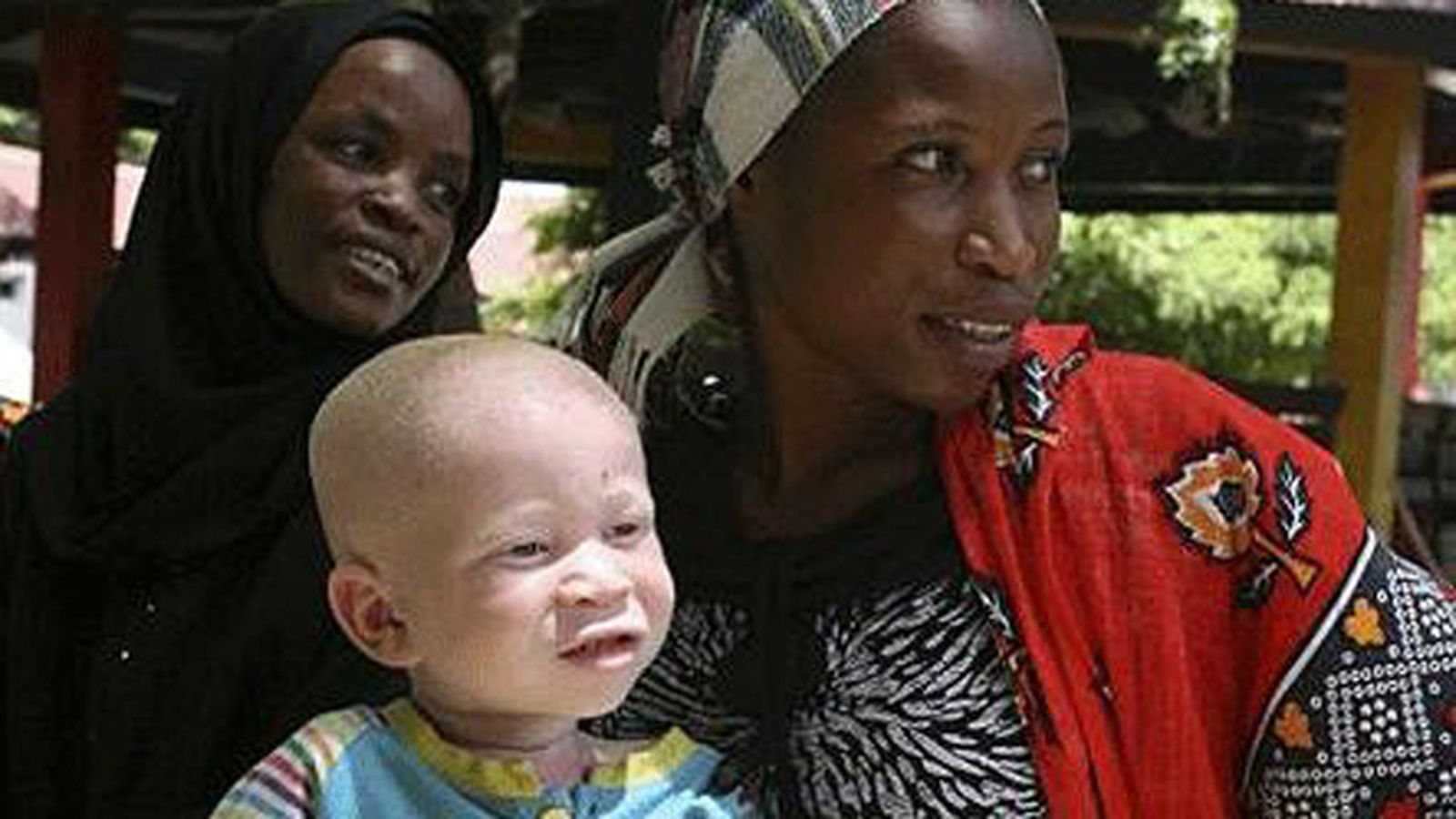 tanzania_albino564
