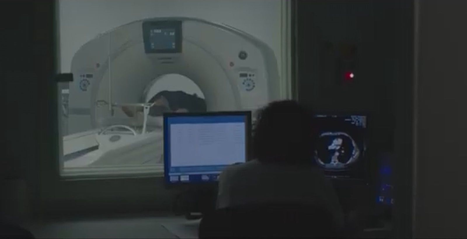 El diagnóstico precoz, imprescindible para curar el cáncer de pulmón, el más mortal en el mundo occidental