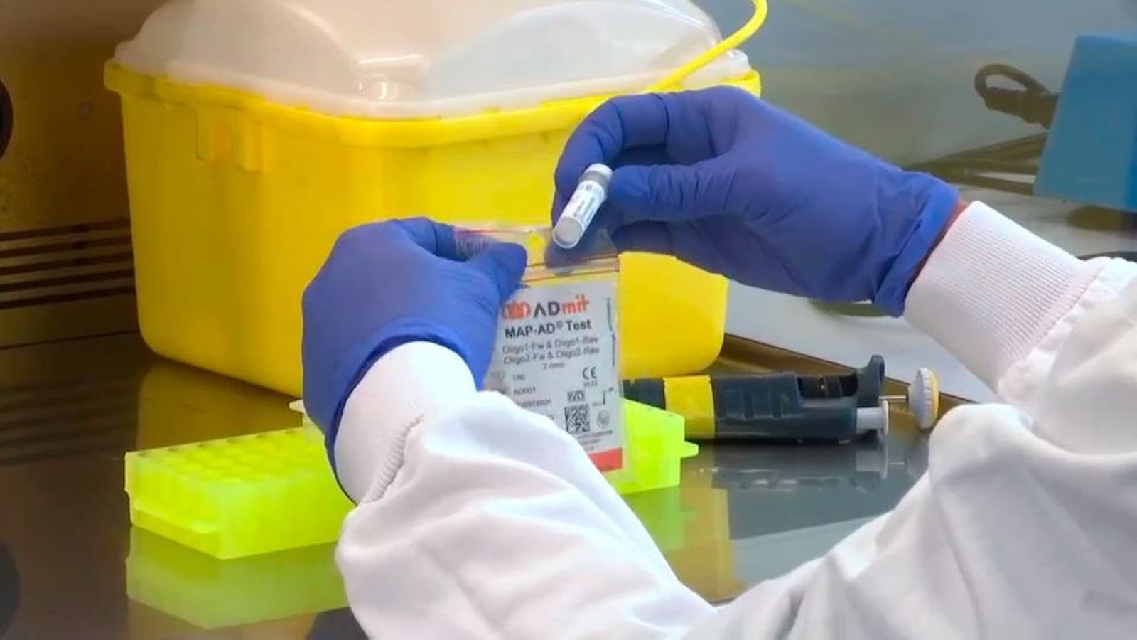 Un nuevo test de sangre anticipa la progresión de deterioro cognitivo leve hacia alzhéimer