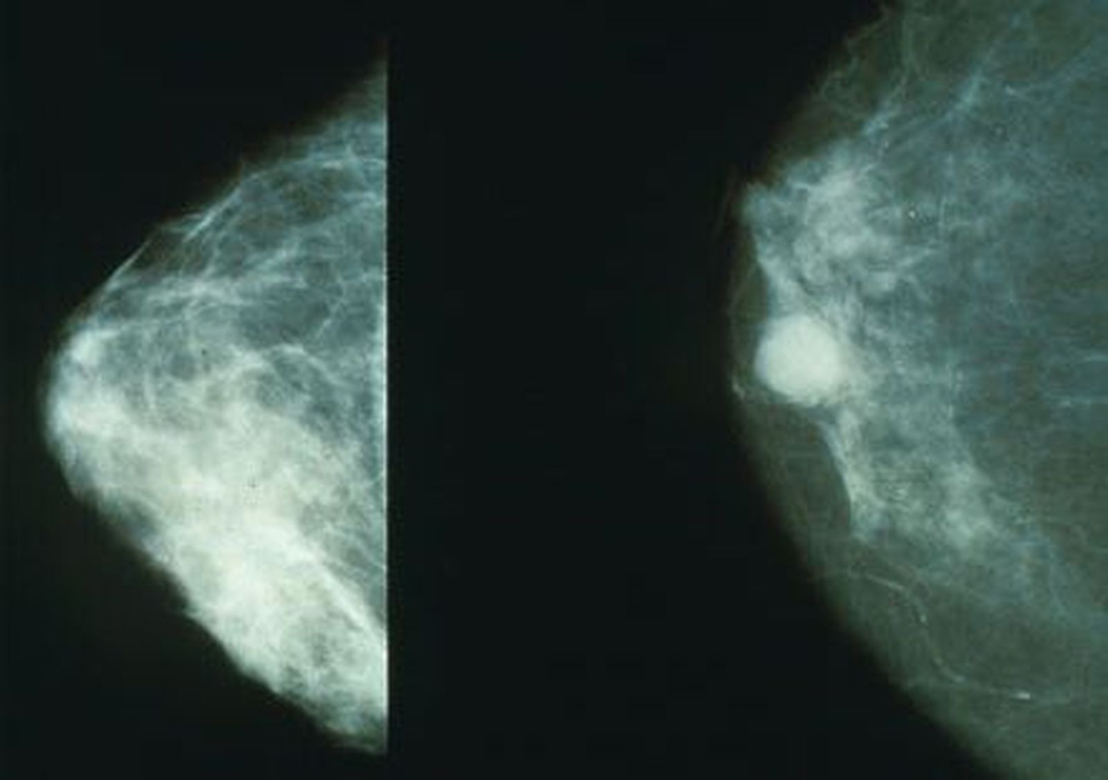 El 95% de las madrileñas sobreviven al cáncer de mama si se detecta pronto