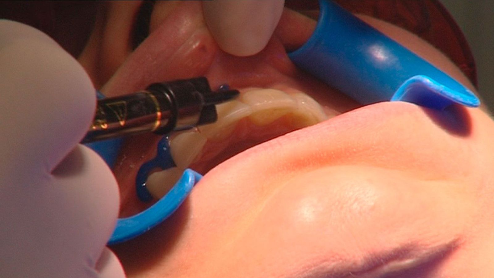 Los dentistas advierten del peligro de comprar productos dentales por internet