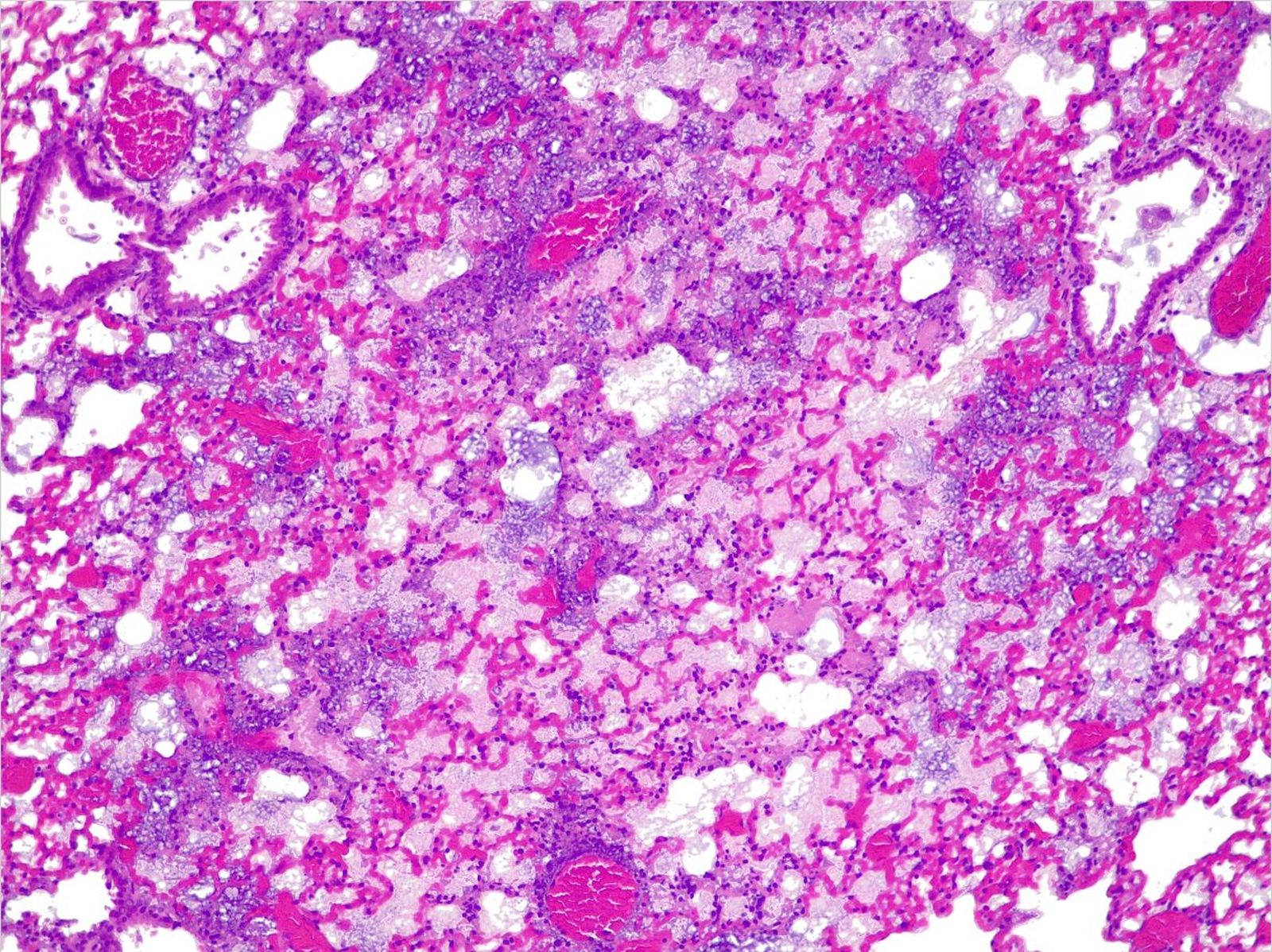 Sección transversal de un pulmón de ratón infectado por Pseudonomas aeruginosa, que provoca una neumonía grave
