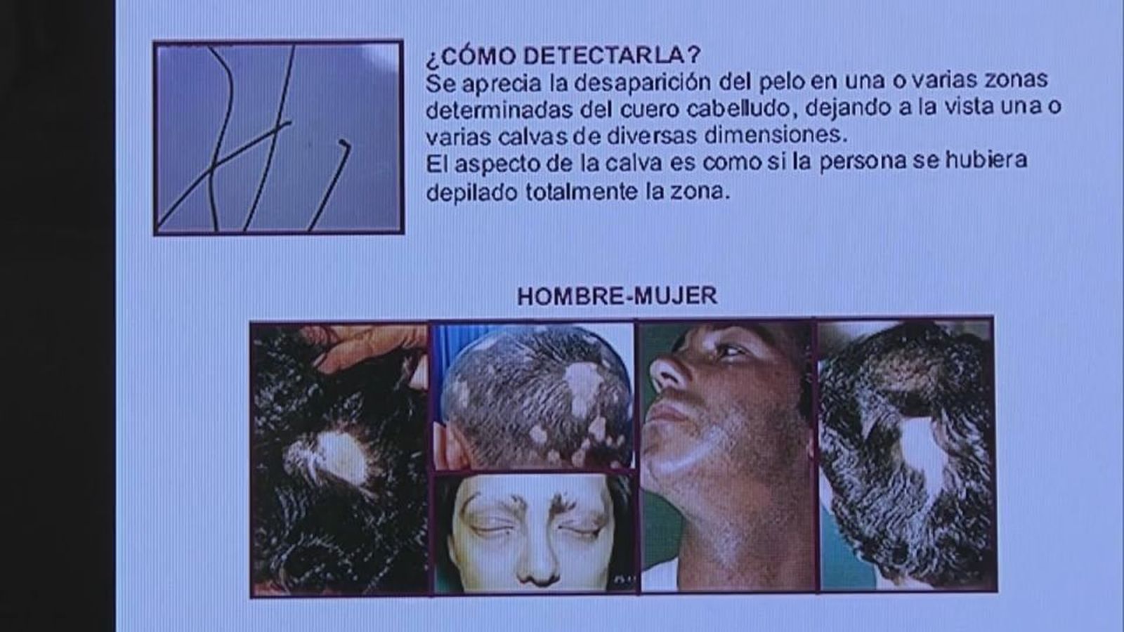 La alopecia y sus causas: una guía sobre los tipos y tratamientos por Madrid Mejora Tu Vida