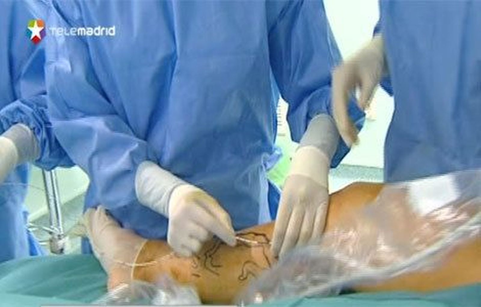 El Hospital de Torrejón introduce el tratamiento láser de las varices