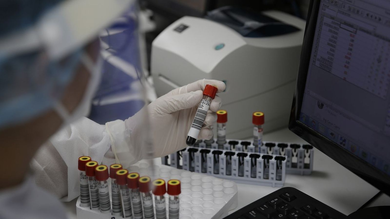 Muestras de sangre para analizar la viruela del mono