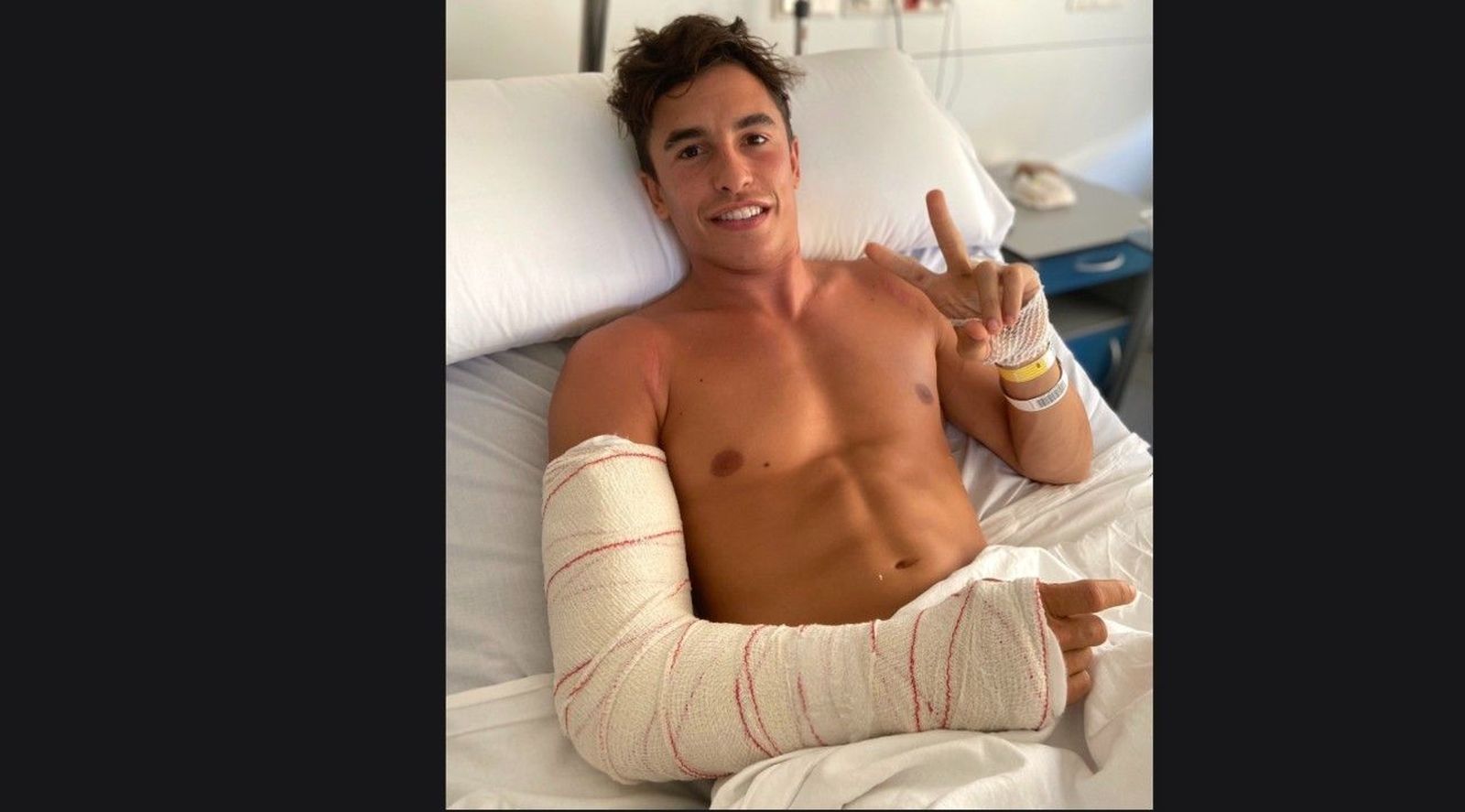 Marc Márquez, en dique seco otros seis meses por una tercera operación
