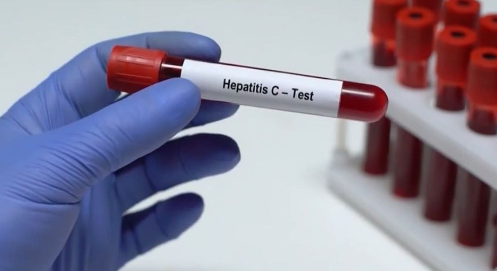 España podría ser el primer país en erradicar la hepatitis C, antes de 2030