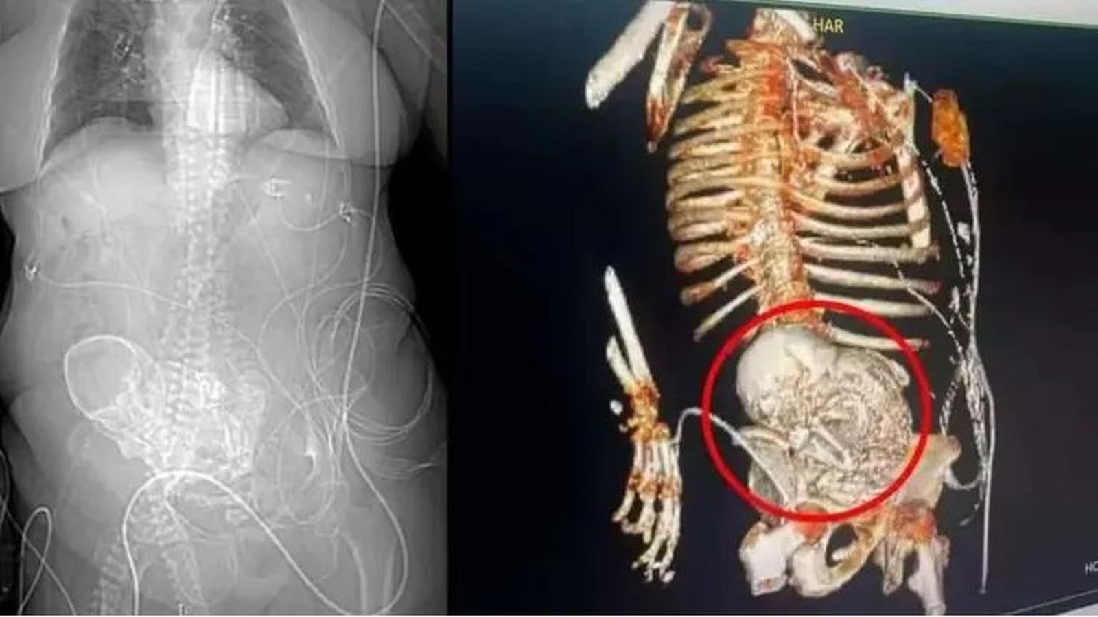 Feto calcificado