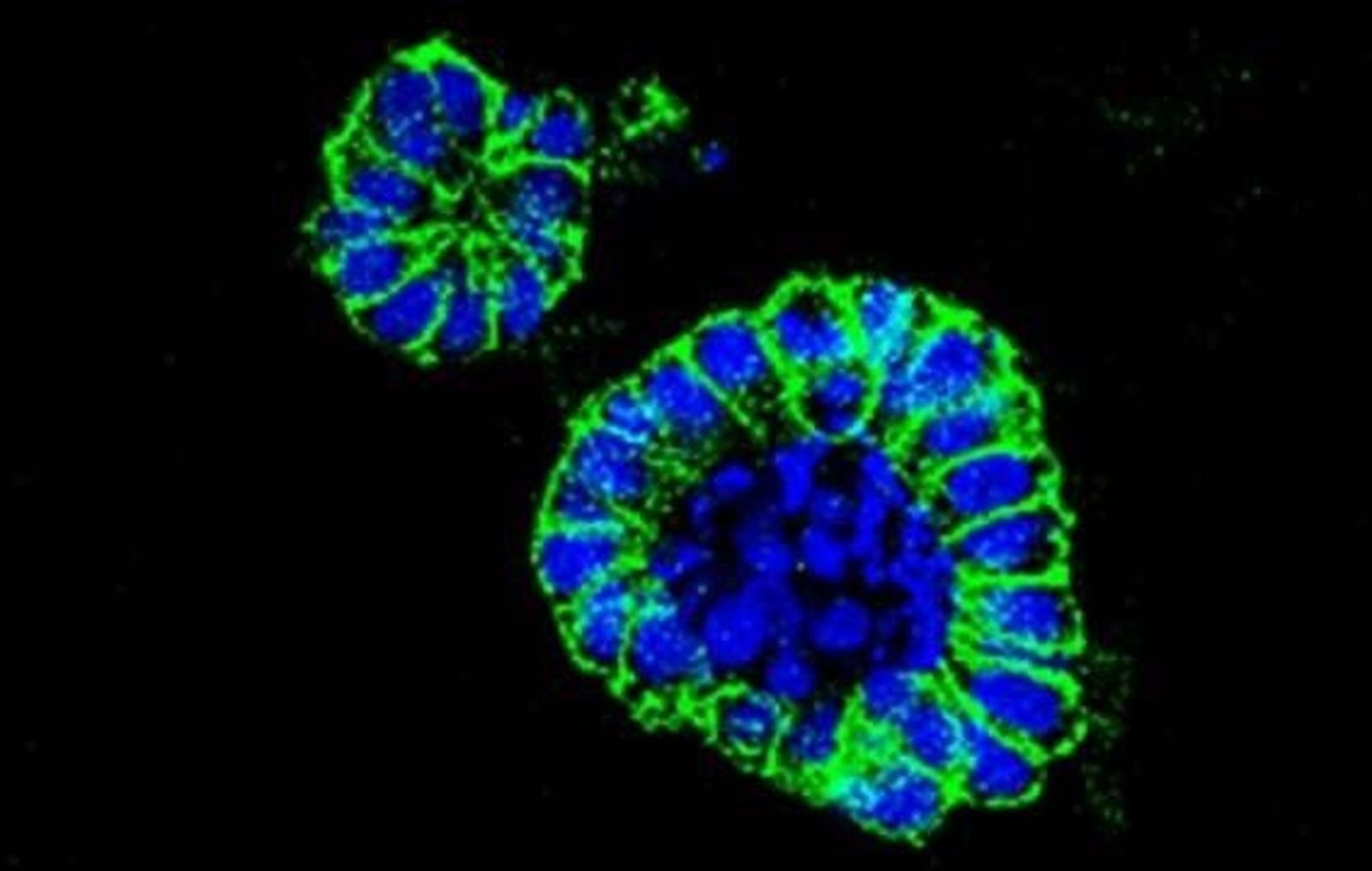 Aumentan los casos de cáncer en España