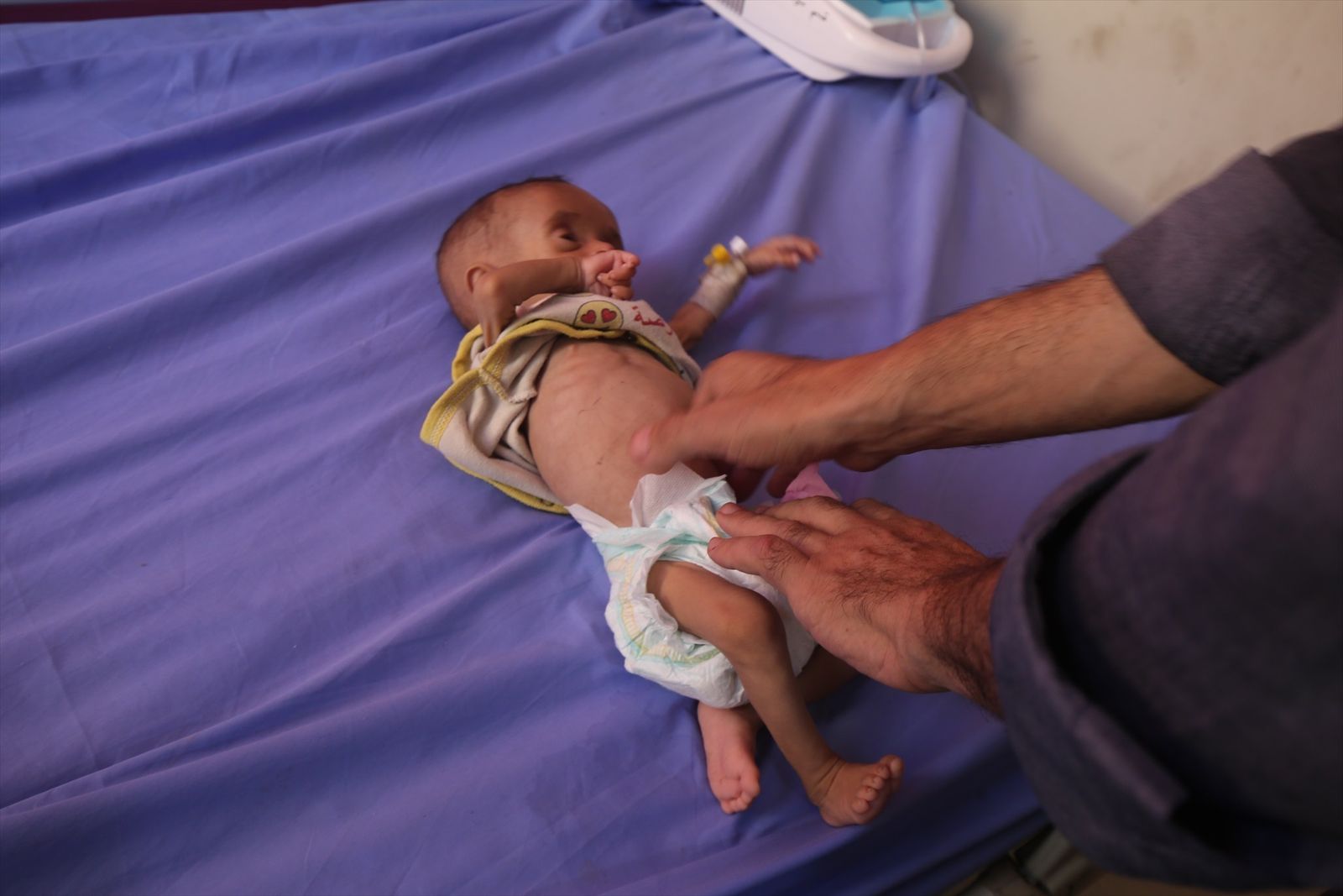 Un bebé con signos de desnutrición es atendido en la Franja de Gaza