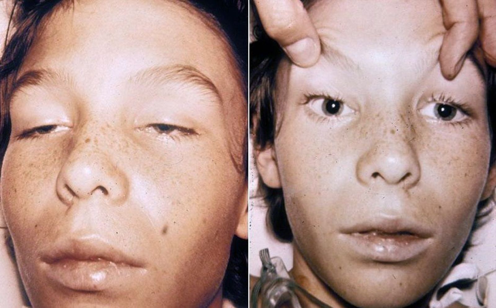 ¿Qué es el botulismo y cuáles son sus síntomas?