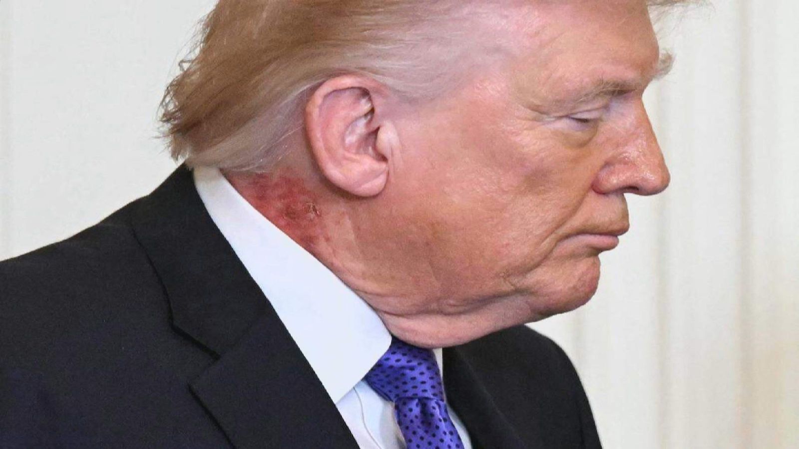 Vuelve a preocupar la salud de Trump por una mancha en su cuello