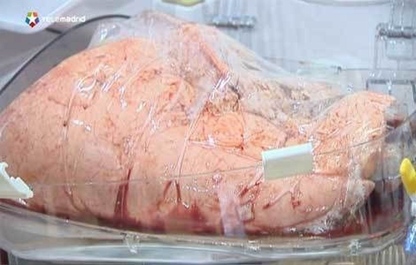 El Puerta de Hierro transplanta pulmones preservados mecánicamente 10 horas