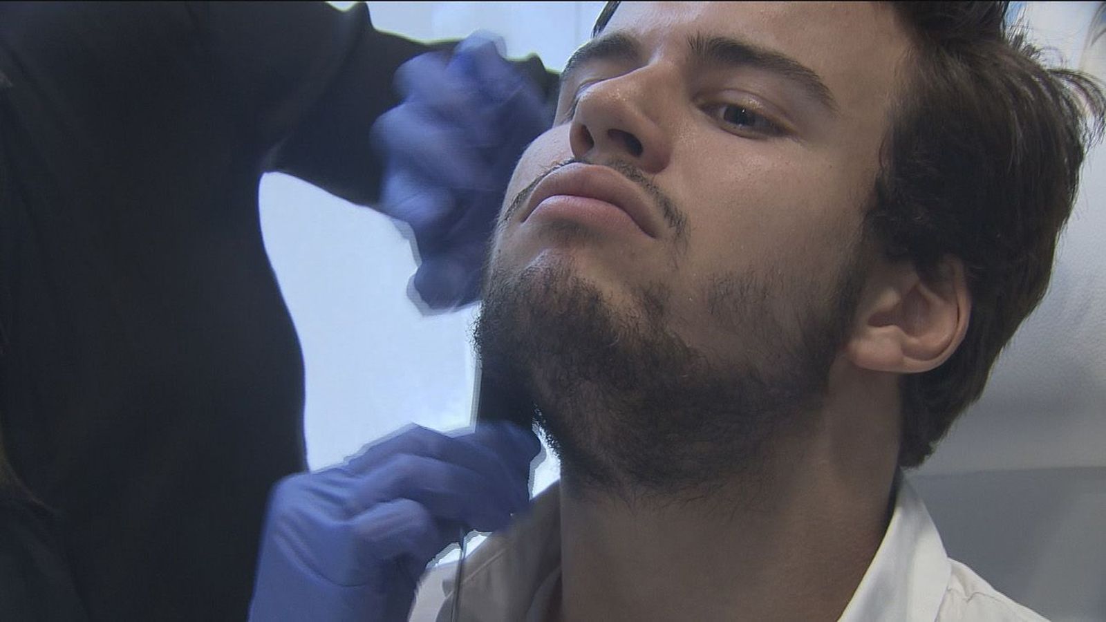 Injertos para repoblar la barba, la última tendencia