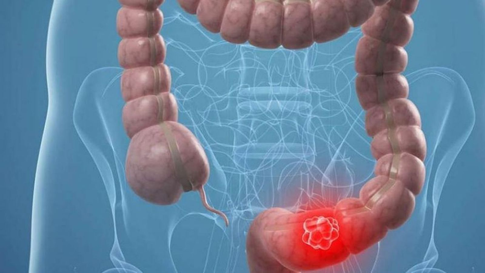Cáncer