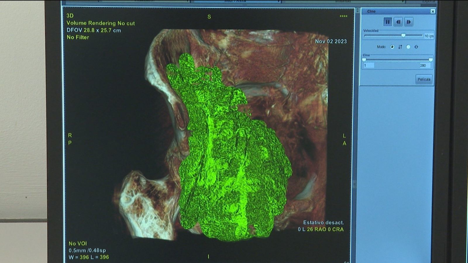 Los hospitales públicos de Madrid usarán la inteligencia artificial en radiología
