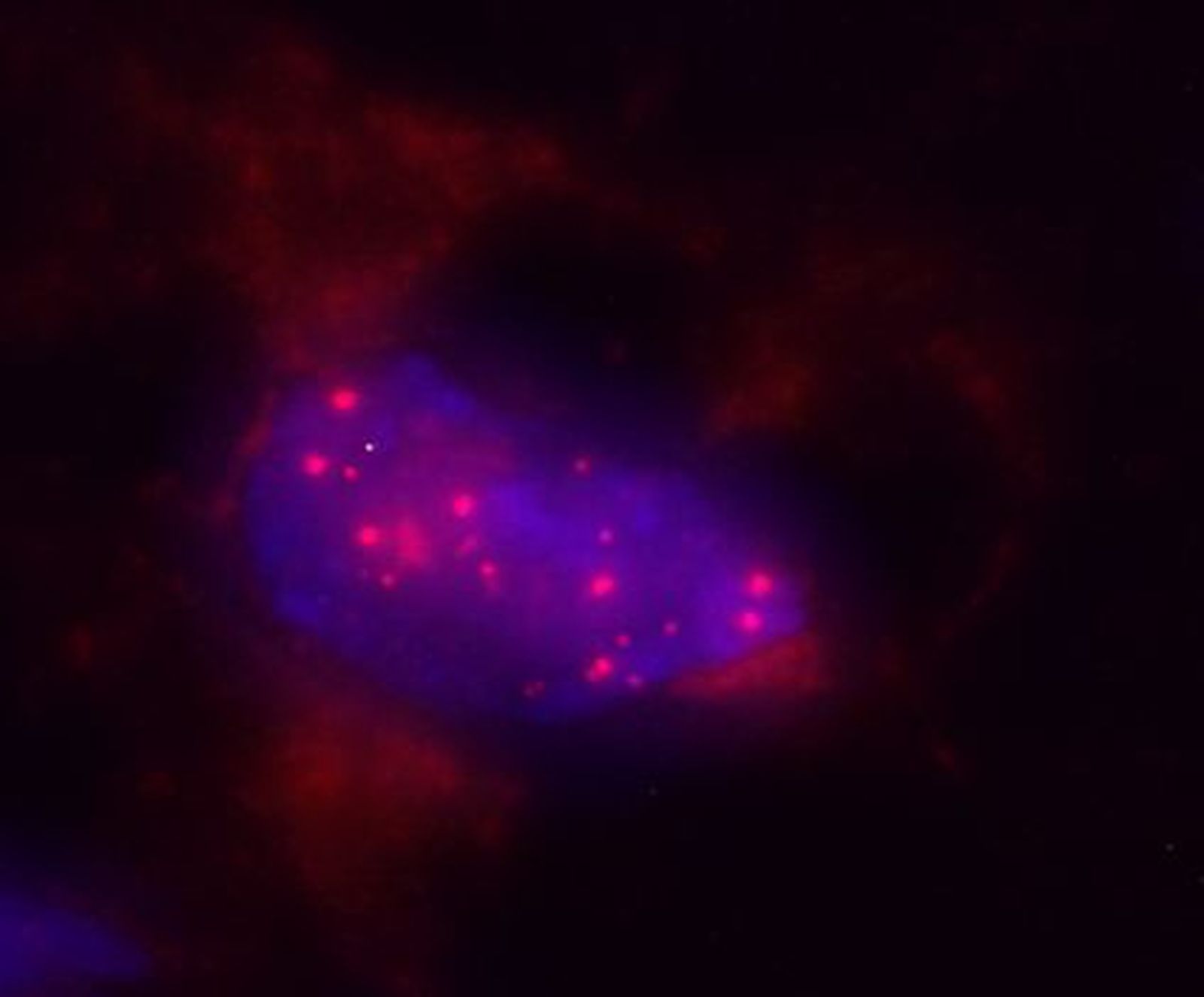 Núcleo de una célula pancreática, en color azul, en el que se observan Bacteroides, en rojo, uno de los microorganismos identificados en el trabajo.