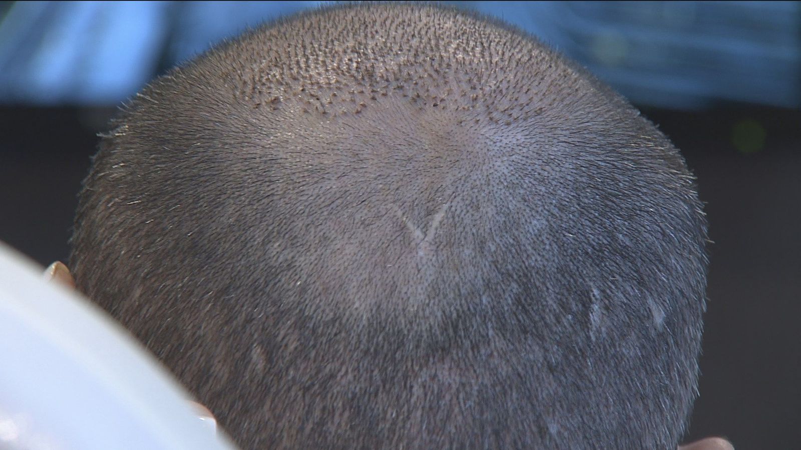 Los implantes de pelo, un negocio en auge en España