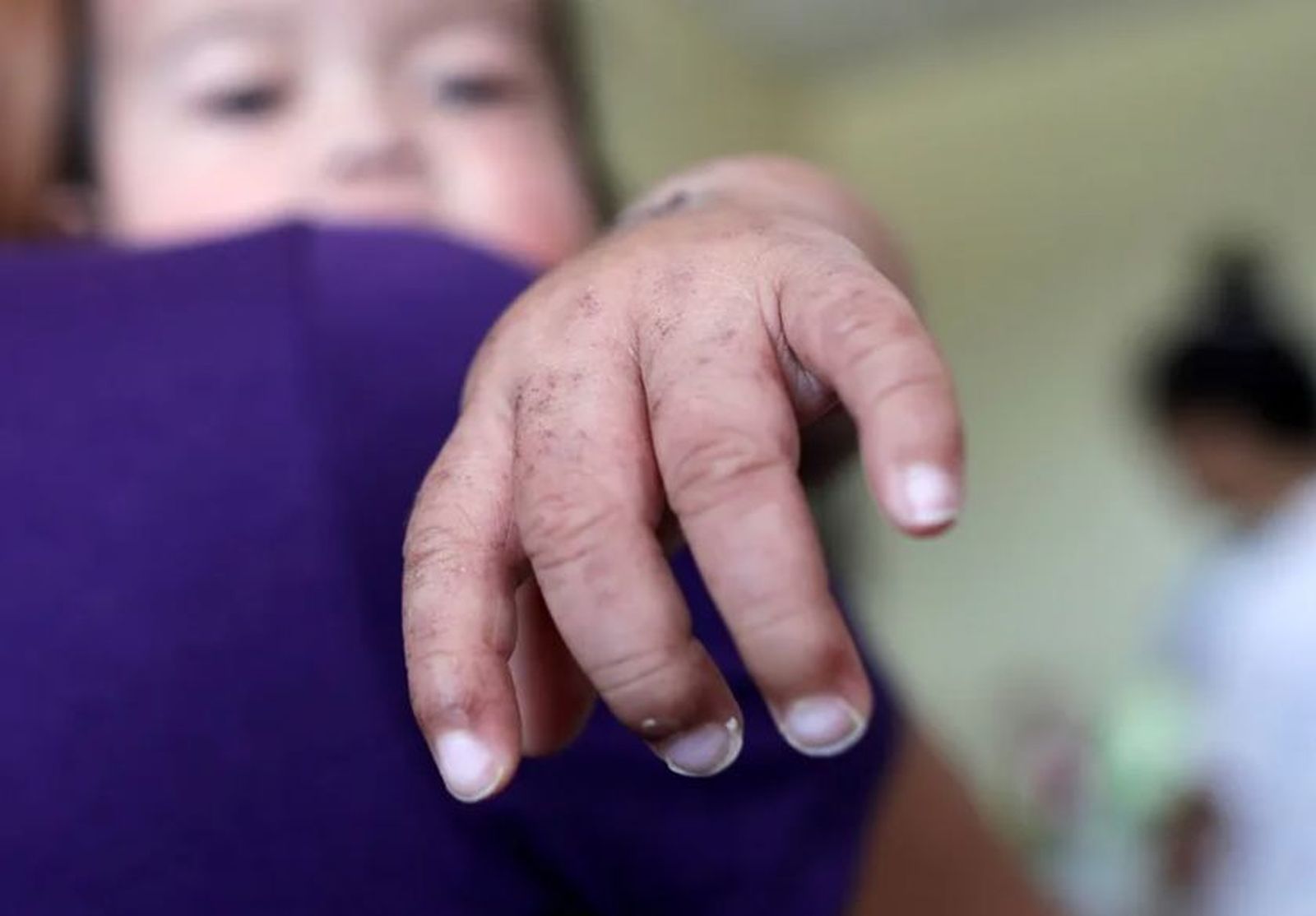 España deja de ser un país libre de sarampión