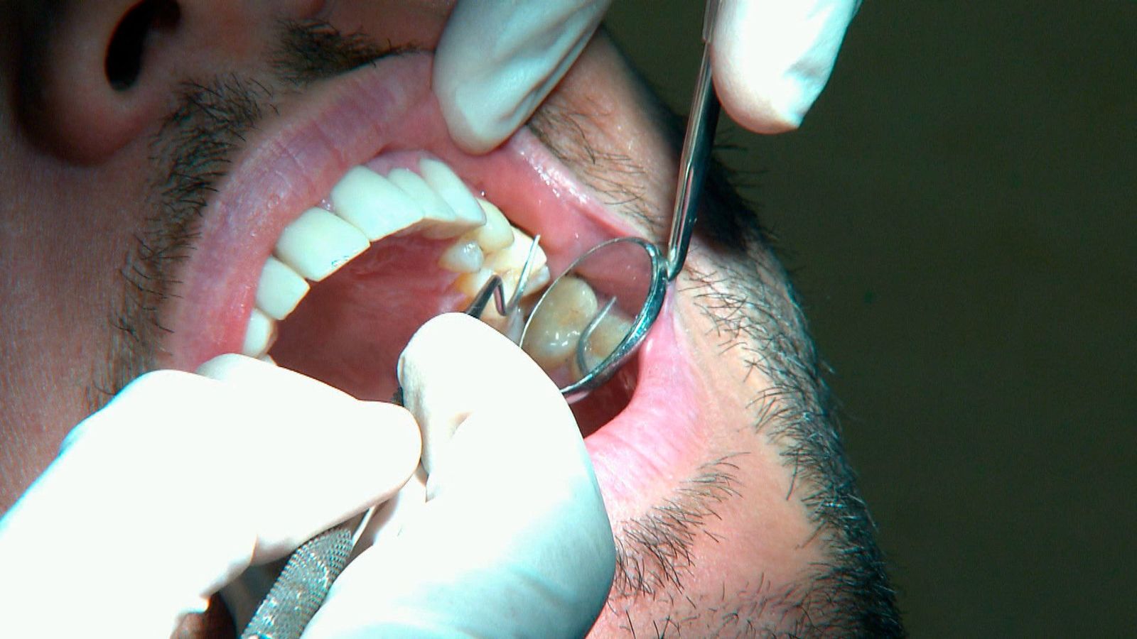 Los españoles retrasamos la visita al dentista por dinero, pereza o miedo