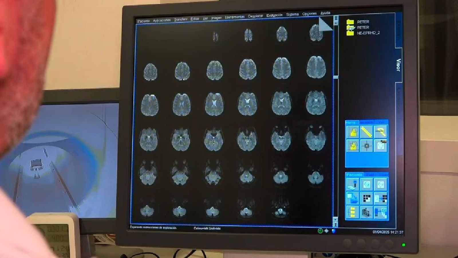 Ensayo del 12 de Octubre pata tratar meningiomas con radiofármacos