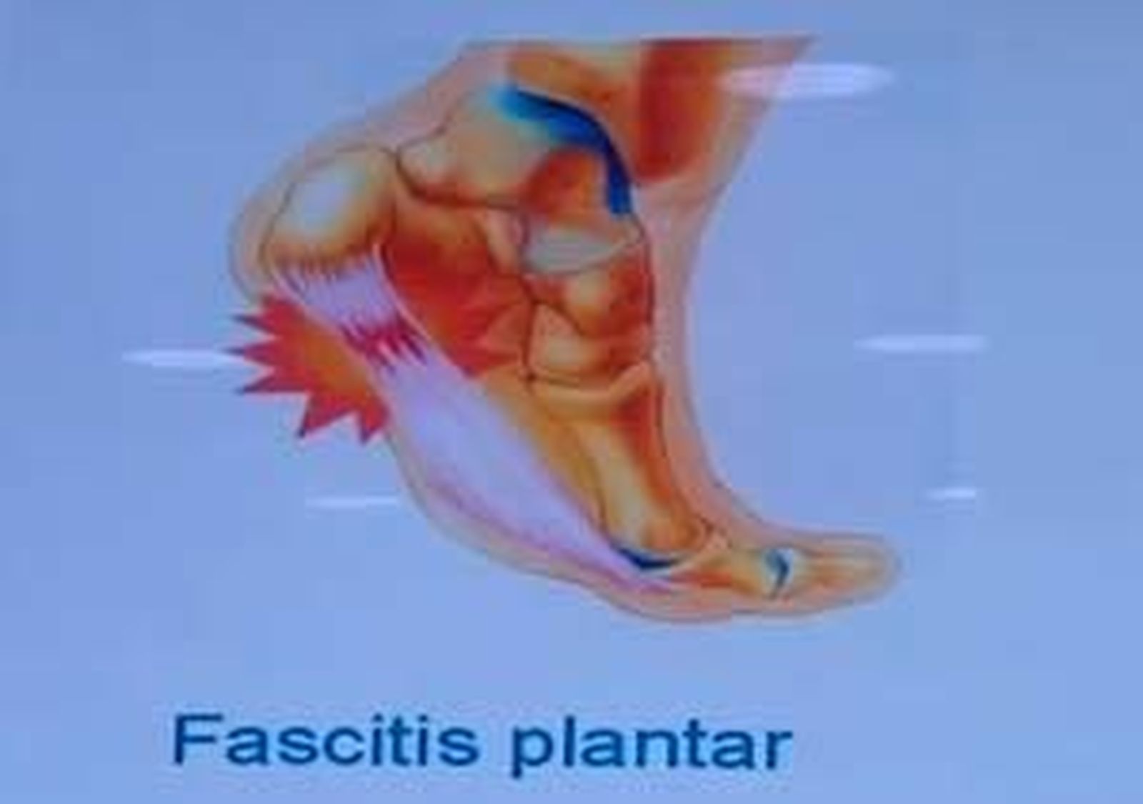 Lesiones en Acción: Fascitis plantar