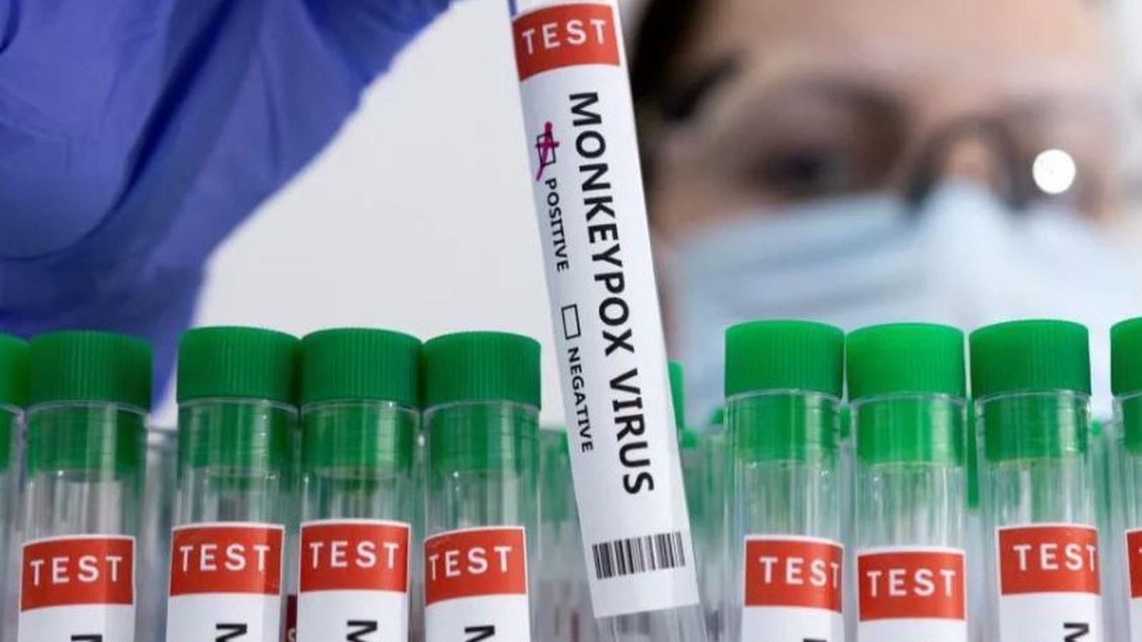 1.535 casos de viruela del mono tras sumar otros 51 positivos en Madrid