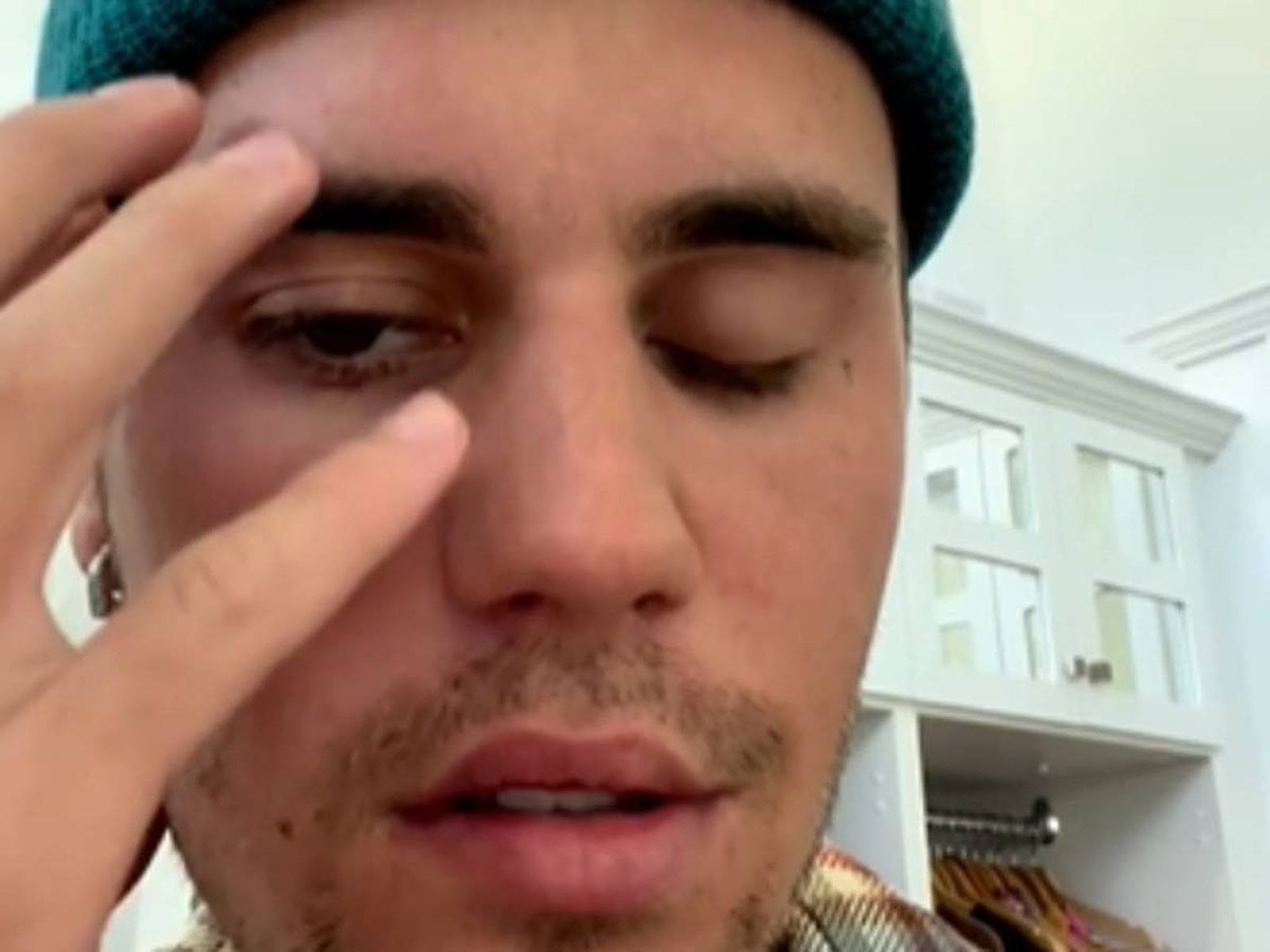 Justin Bieber con parálisis facial