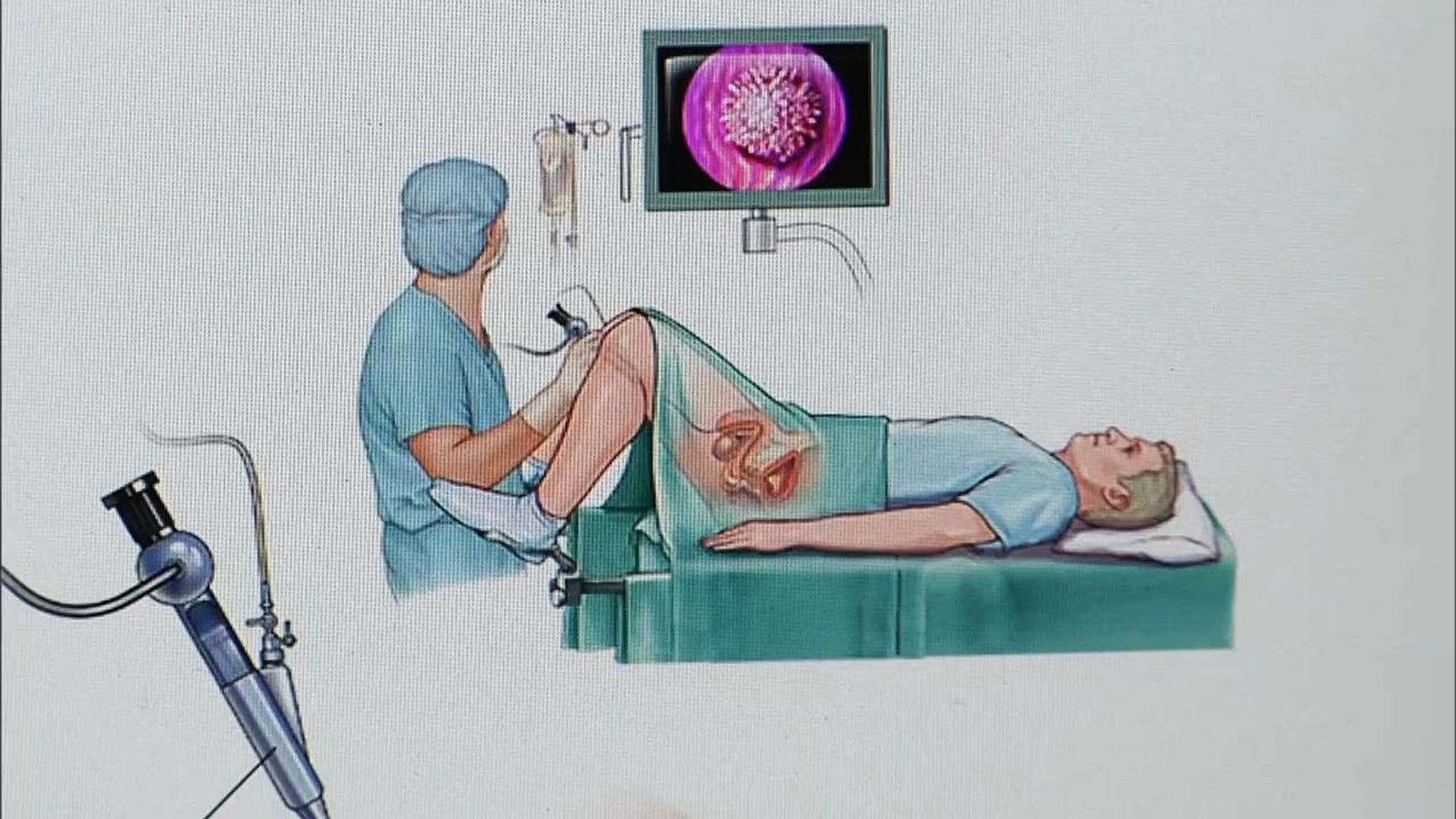 El Hospital 12 de Octubre lleva a cabo un ensayo clínico para la detección precoz del cáncer de vejiga