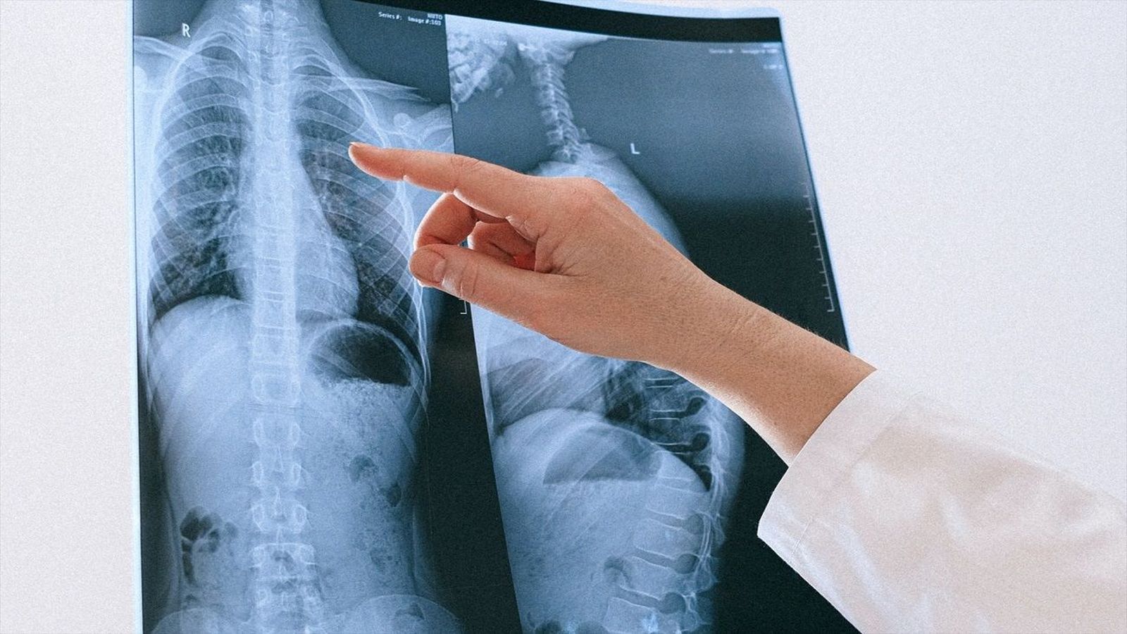 Llega a Madrid el primer equipo de radiografía móvil de Europa