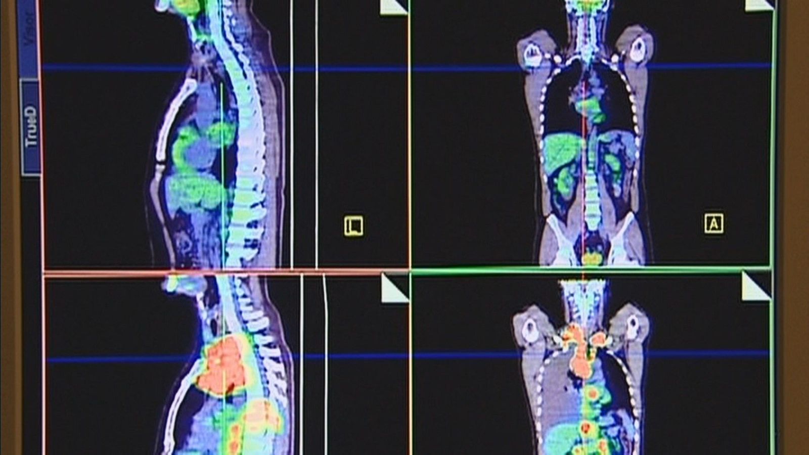 La FJD ensaya en humanos la primera vacuna contra el cáncer de pulmón