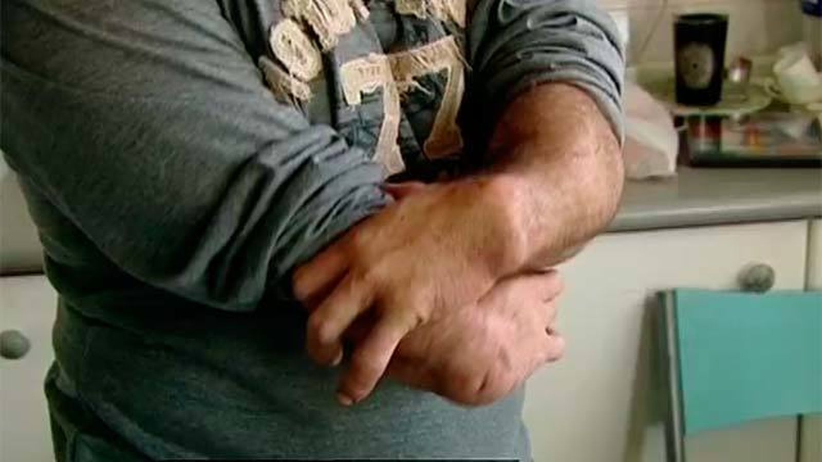 Afectados por la talidomida