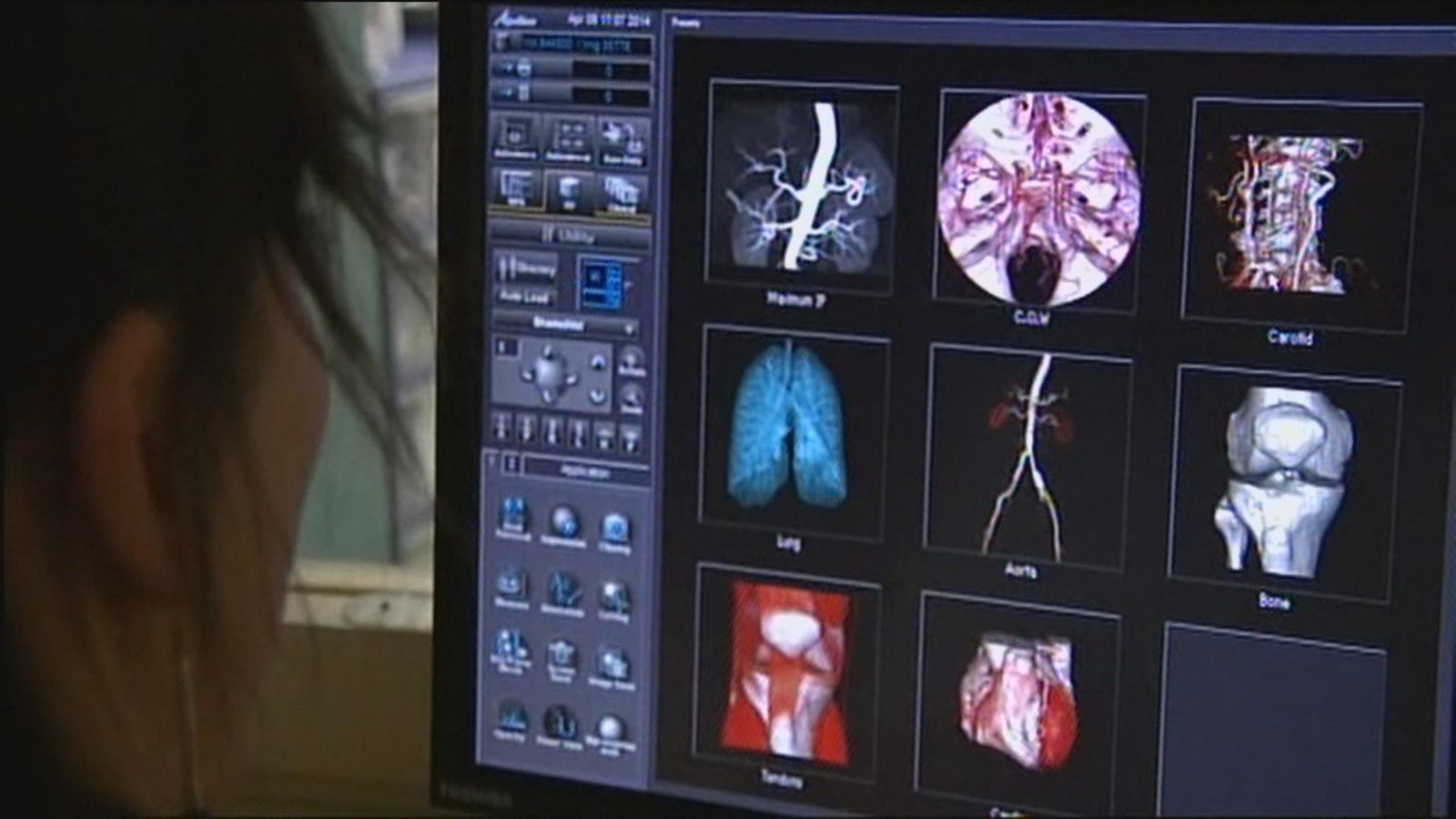 Arranca en Madrid un programa para la detección precoz del cáncer de pulmón