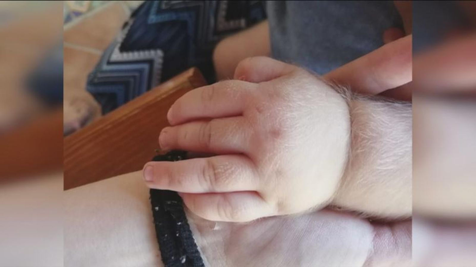 Un niño afectado por hipertricosis,  el denominado 'síndrome del hombre lobo'