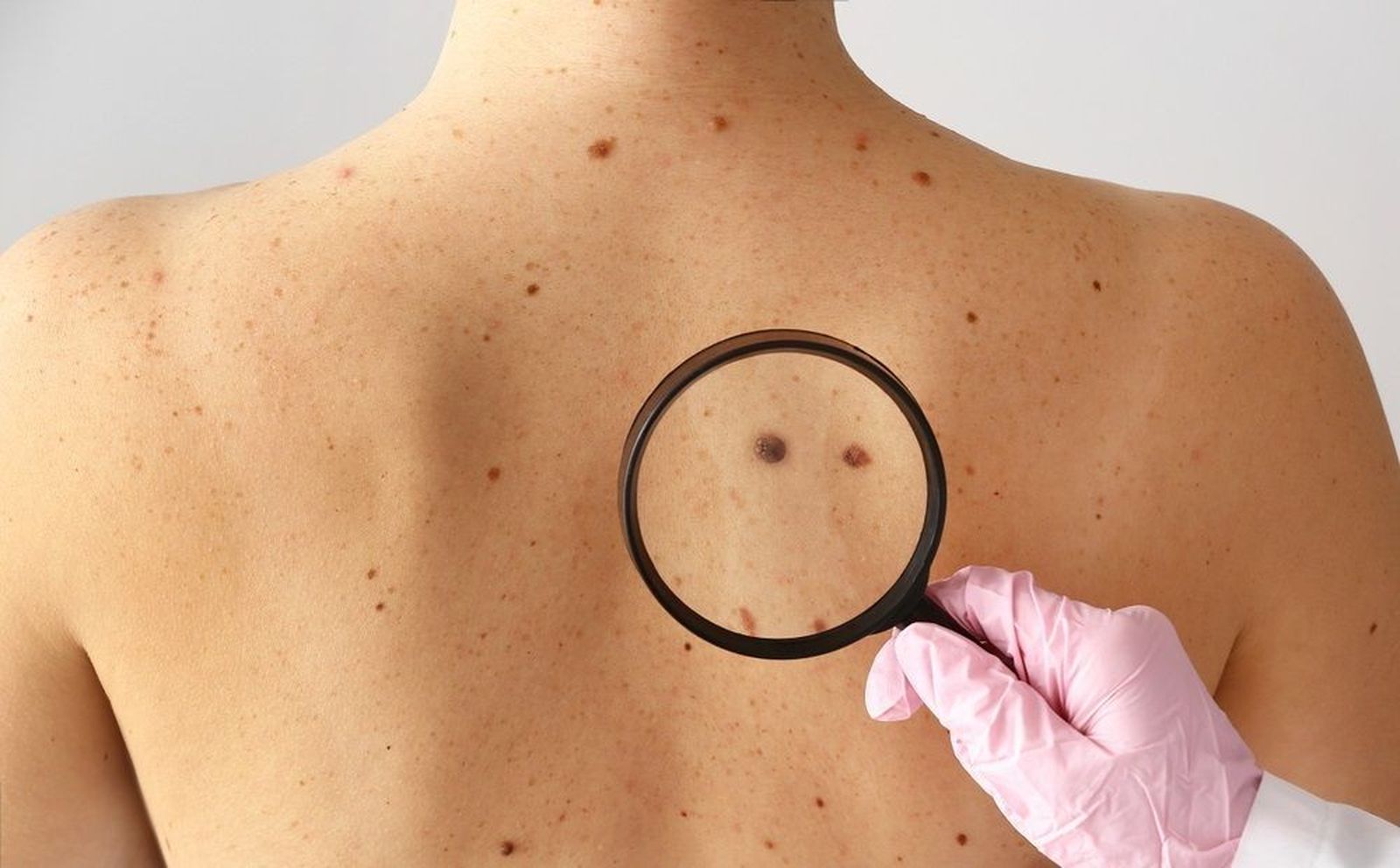 Uno de cada cinco españoles padecerá cáncer de piel en los próximos años