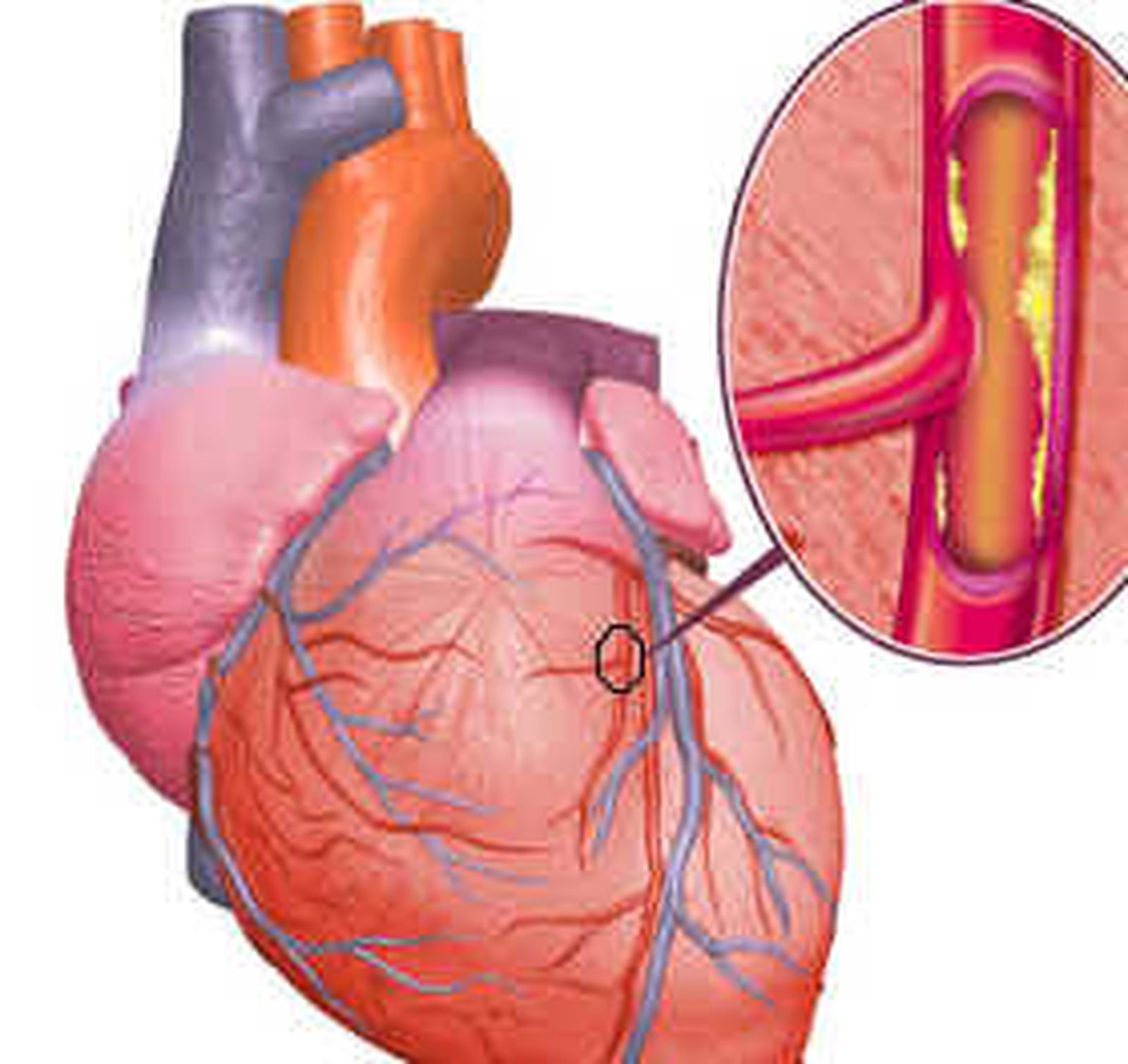 Enfermedades cardiovasculares