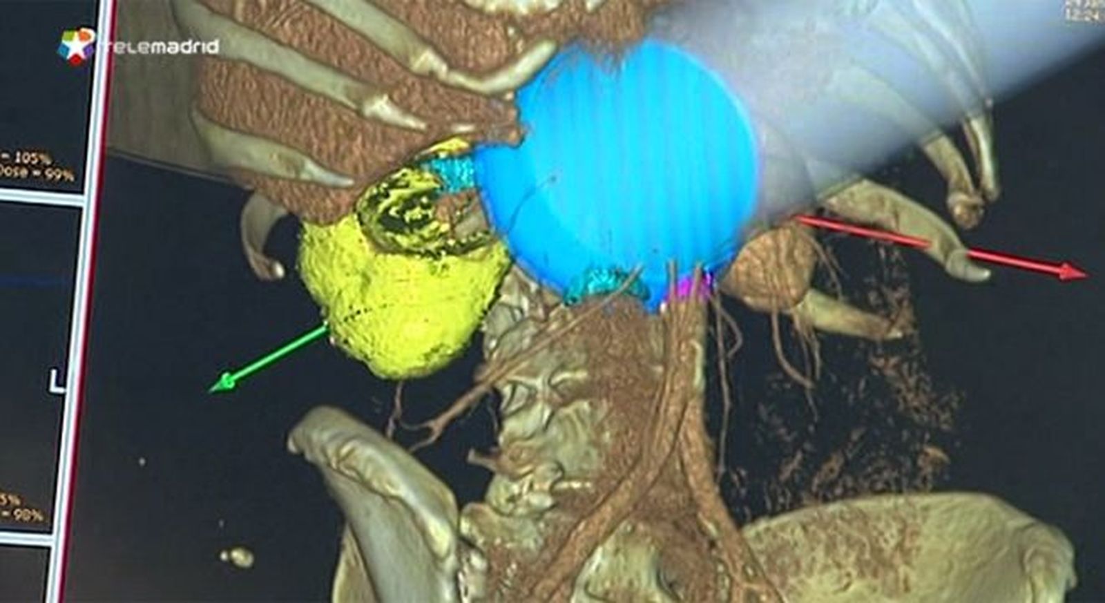Nace el primer 'acelerador lineal de electrones' para tratar  el cáncer