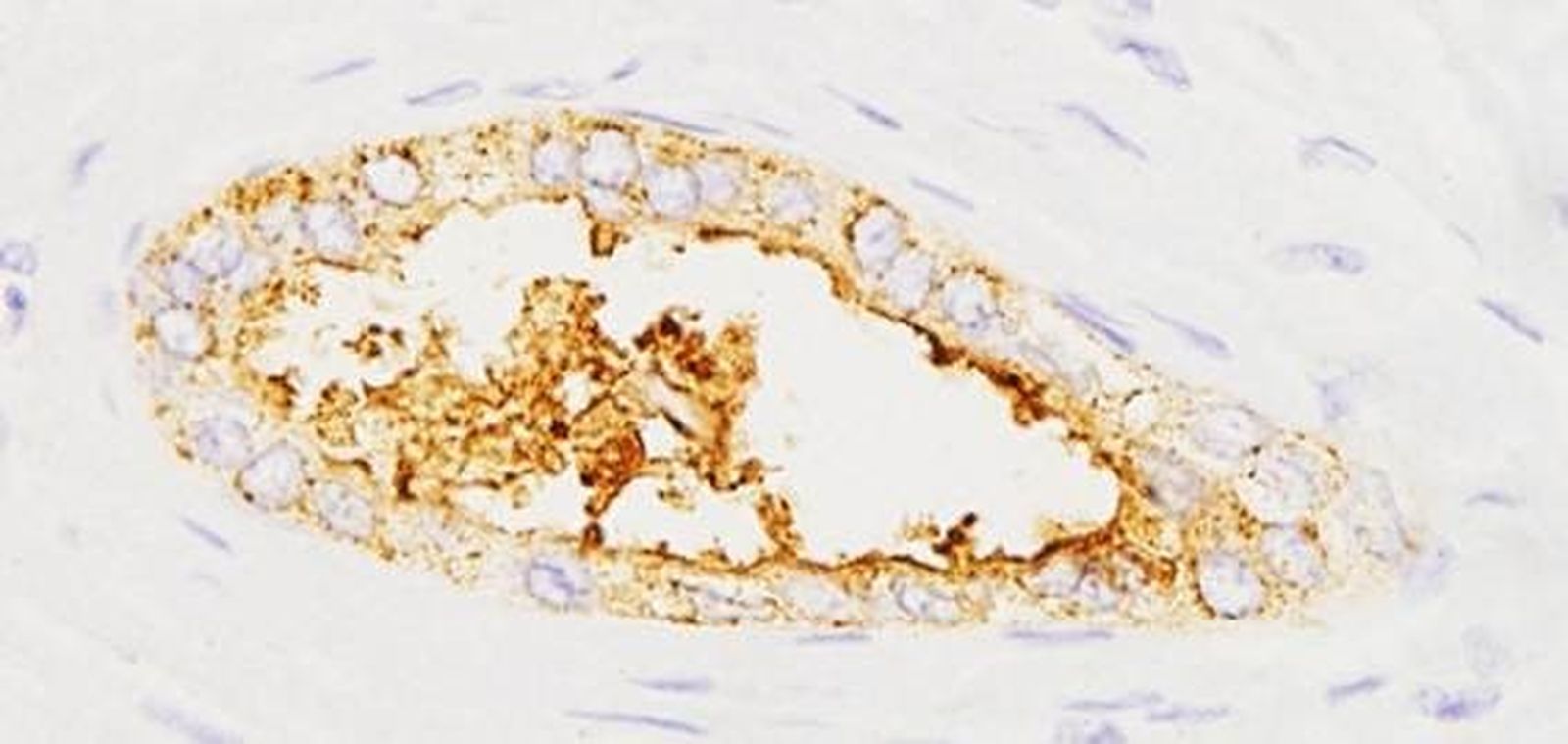 Expresión de la proteína sAXL en tumores pancreáticos