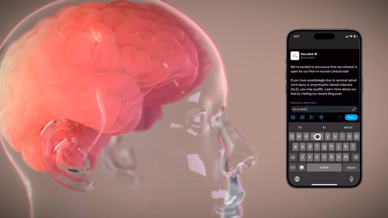 Esquema de funcionamiento del primer chip cerebral implantado en un ser humano