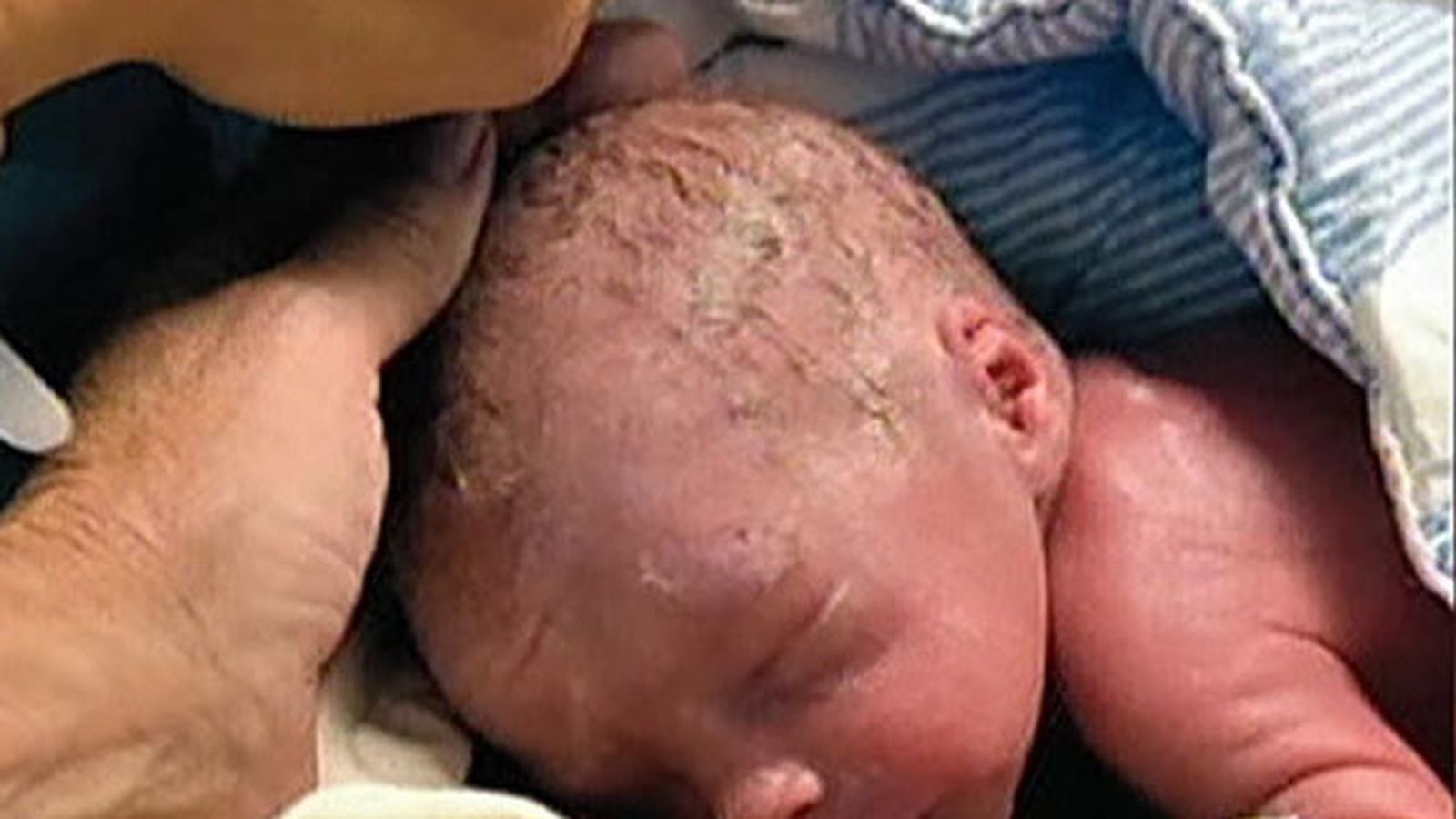 Trasplante bebe
