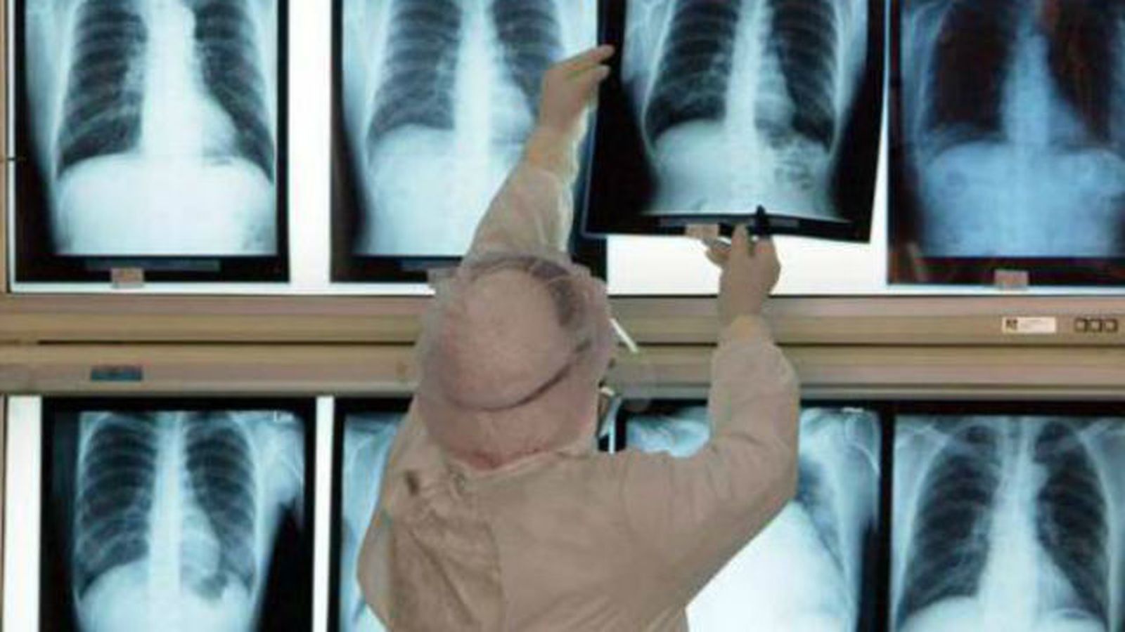 Expertos instan a vacunarse de neumonía, que causa más de 8.000 muertes al año