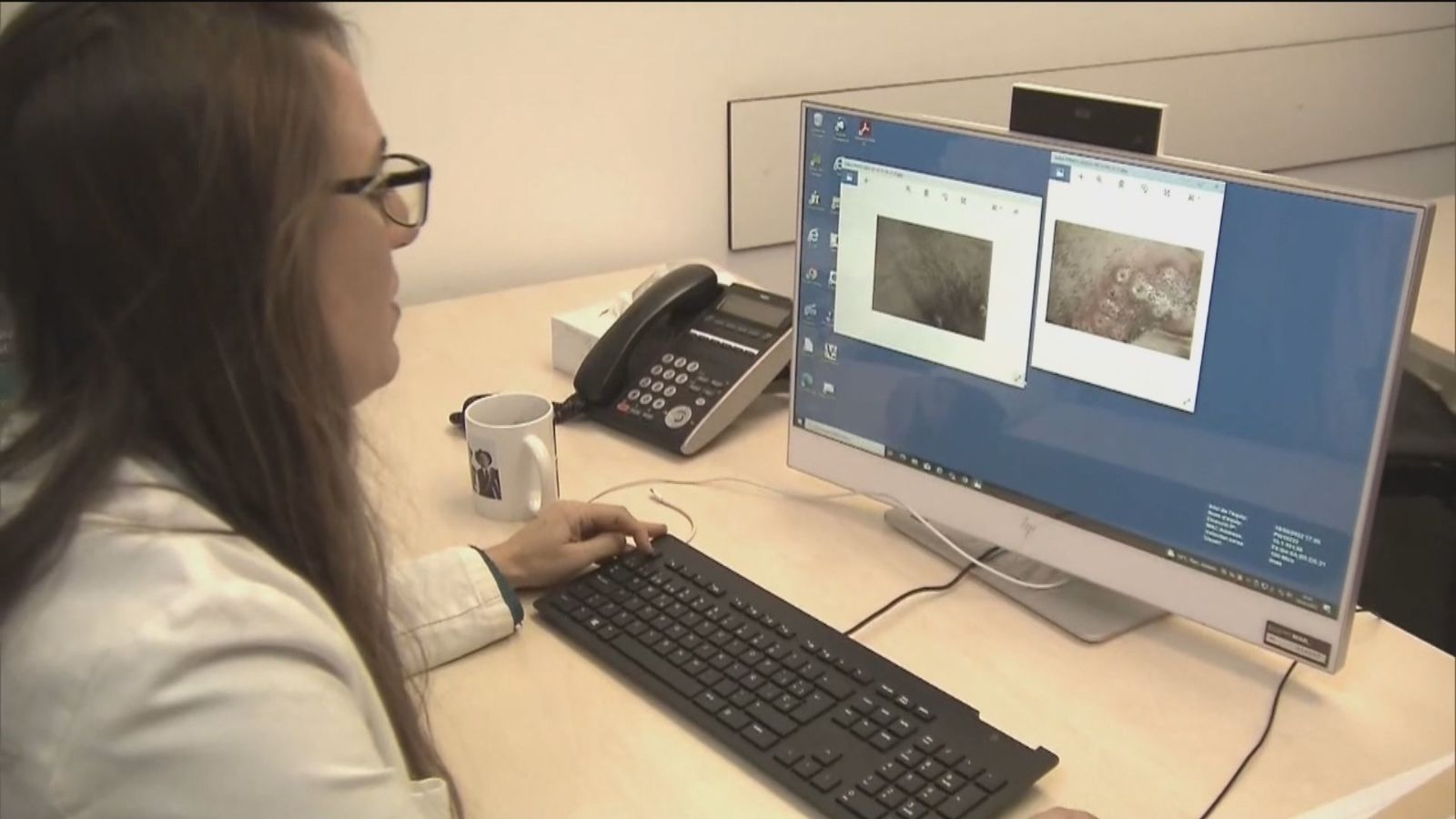 Europa recomienda la identificación rápida y el rastreo de casos de viruela del mono