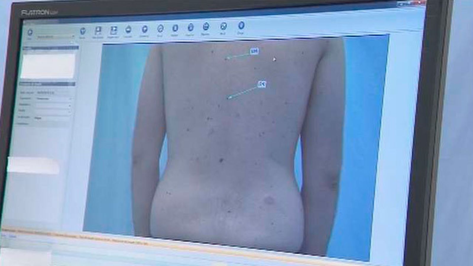 Cuatro de cada 10 españoles acabarán sufriendo un cáncer de piel
